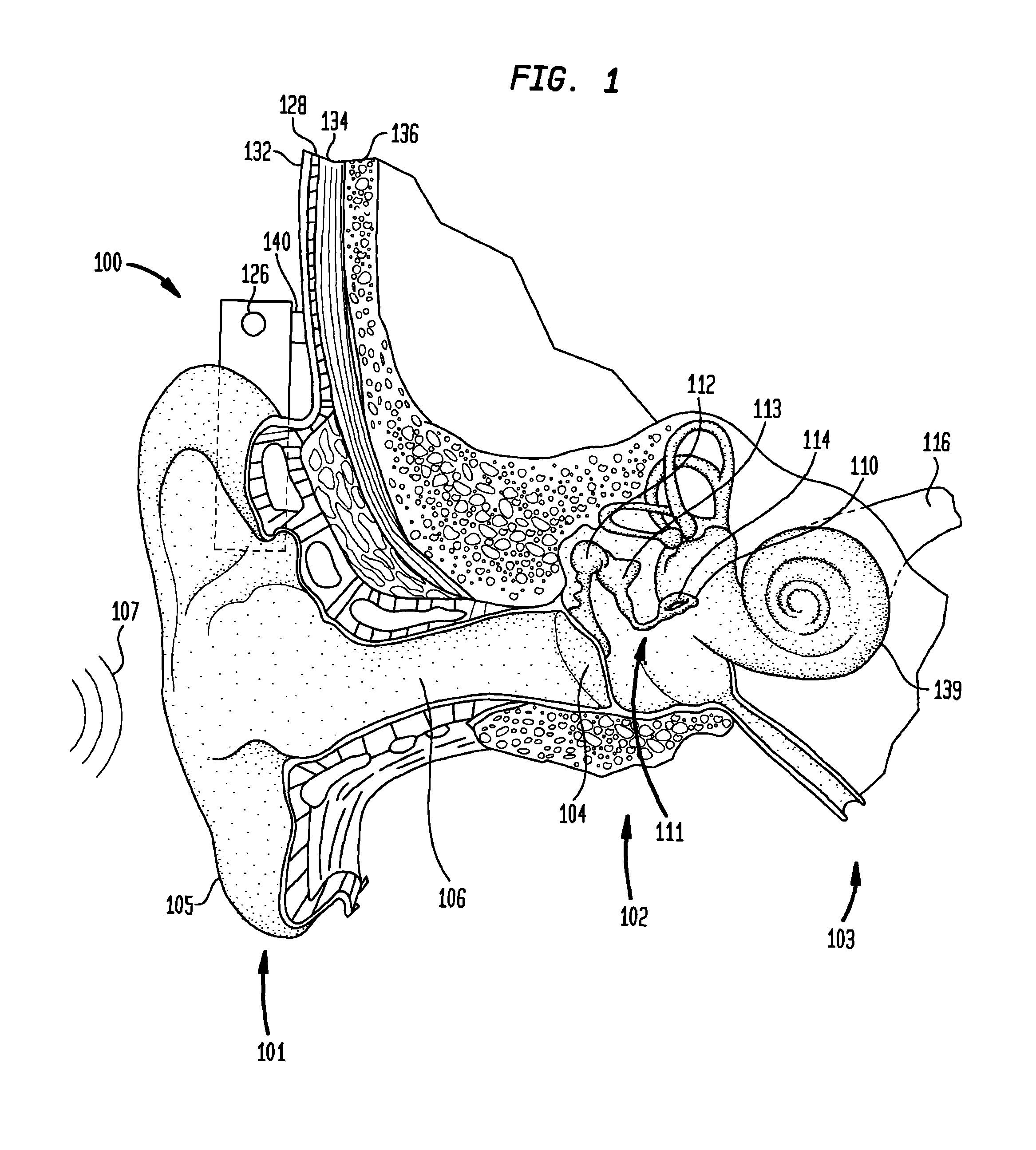 Bone conduction device having limited range of travel