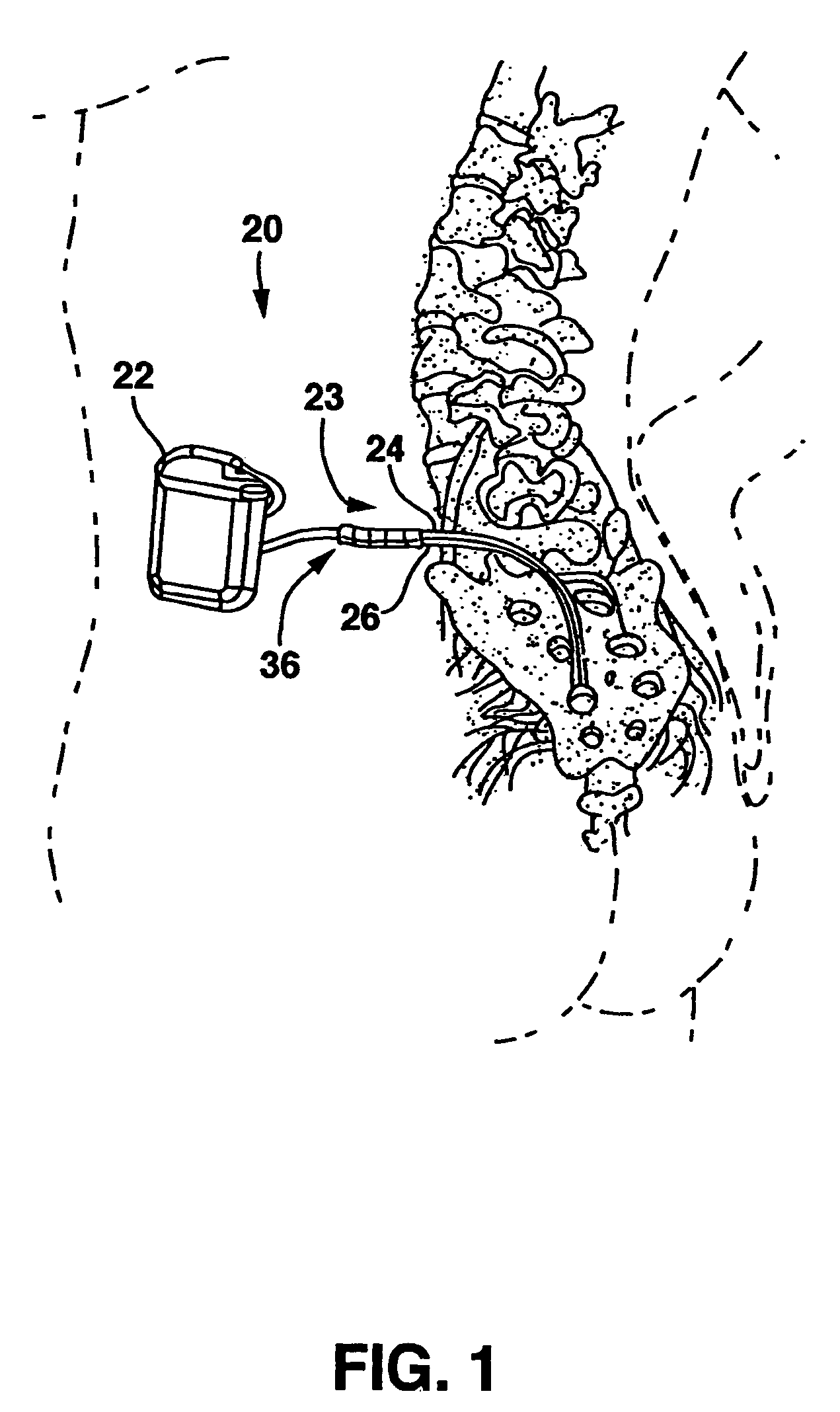 Method of use of implantable percutaneous stimulation lead