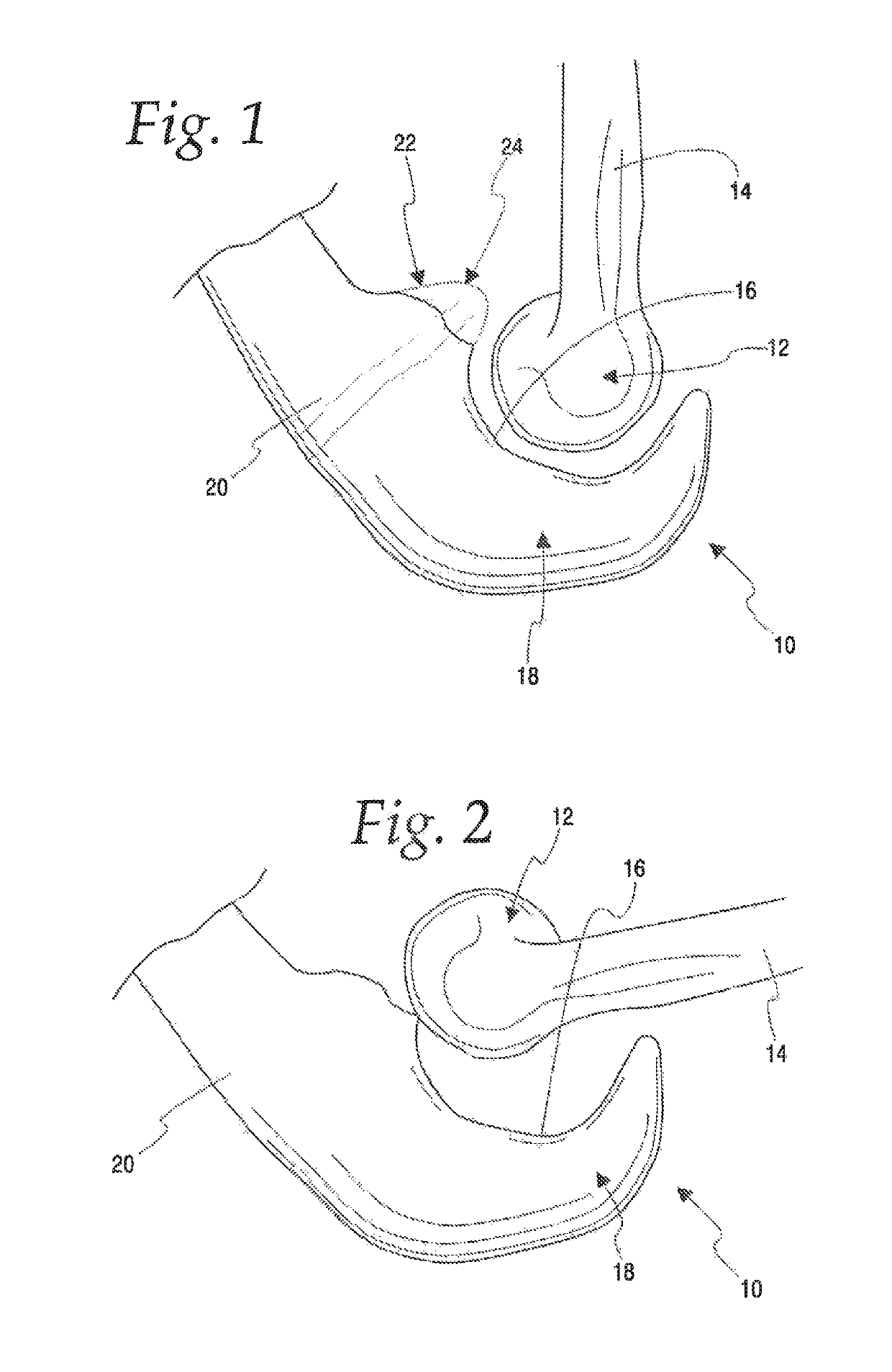 Method of stabilizing a patients ulnohumeral joint