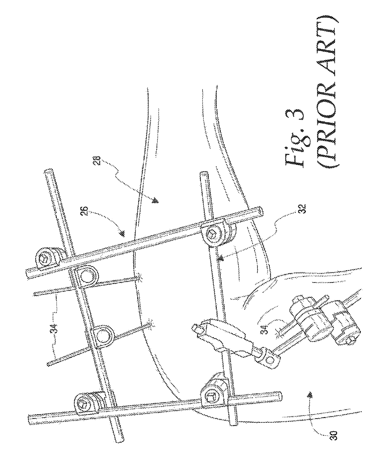 Method of stabilizing a patients ulnohumeral joint