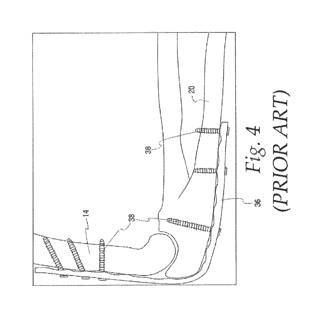 Method of stabilizing a patients ulnohumeral joint