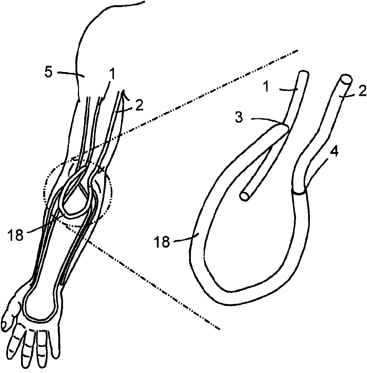 Hemodialysis arterio-venous graft with a ring-like diameter-adjustable device
