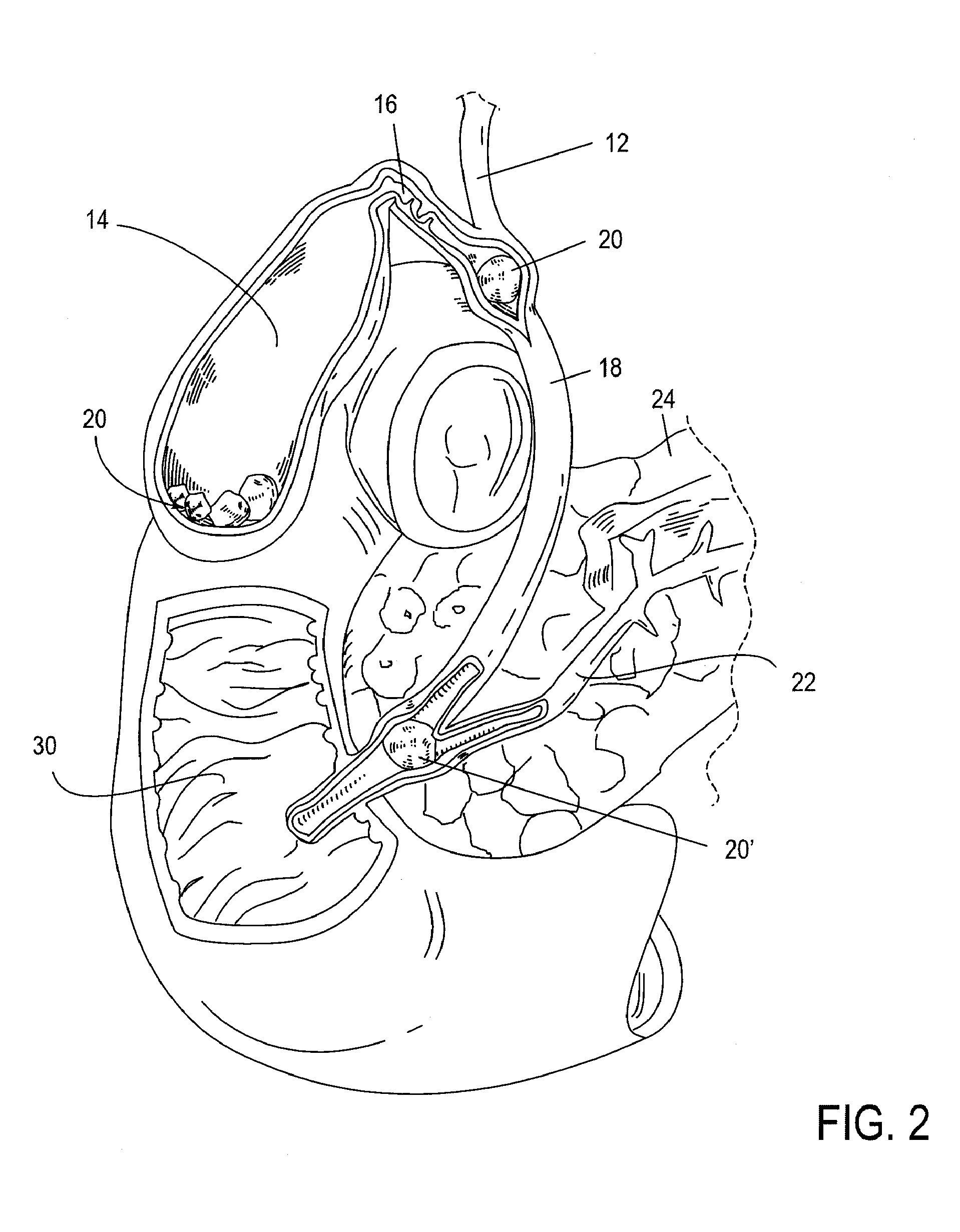 Methods, Devices, Kits and Systems for Defunctionalizing the Gallbladder