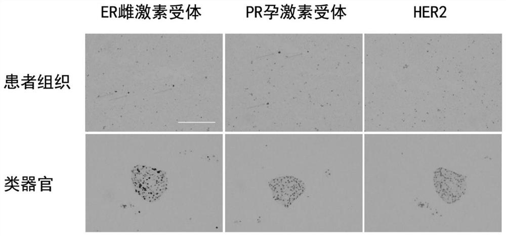 Breast cancer organoid culture solution, preparation method and culture method