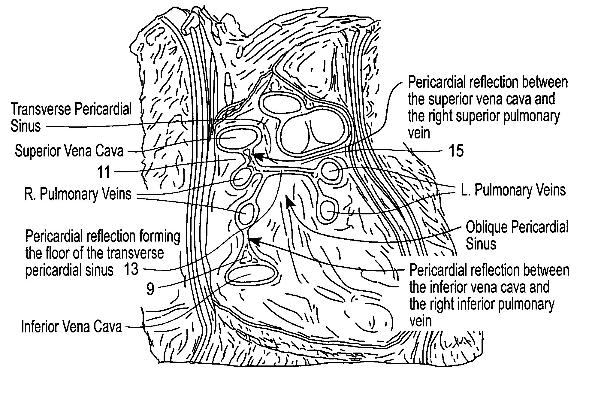Apparatus and method for endoscopic encirclement of pulmonary veins for epicardial ablation