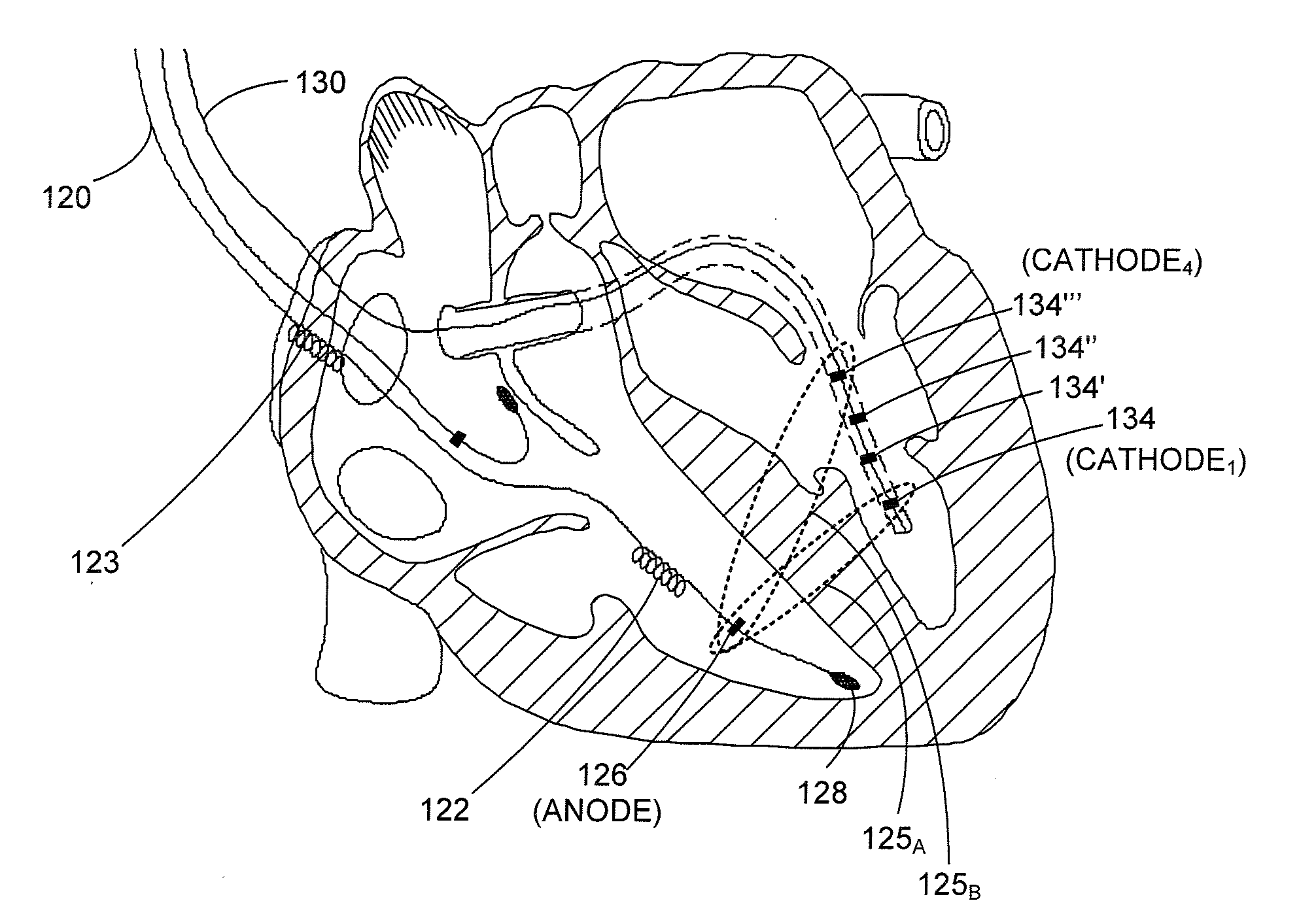 Anodal Stimulation Detection and Avoidance