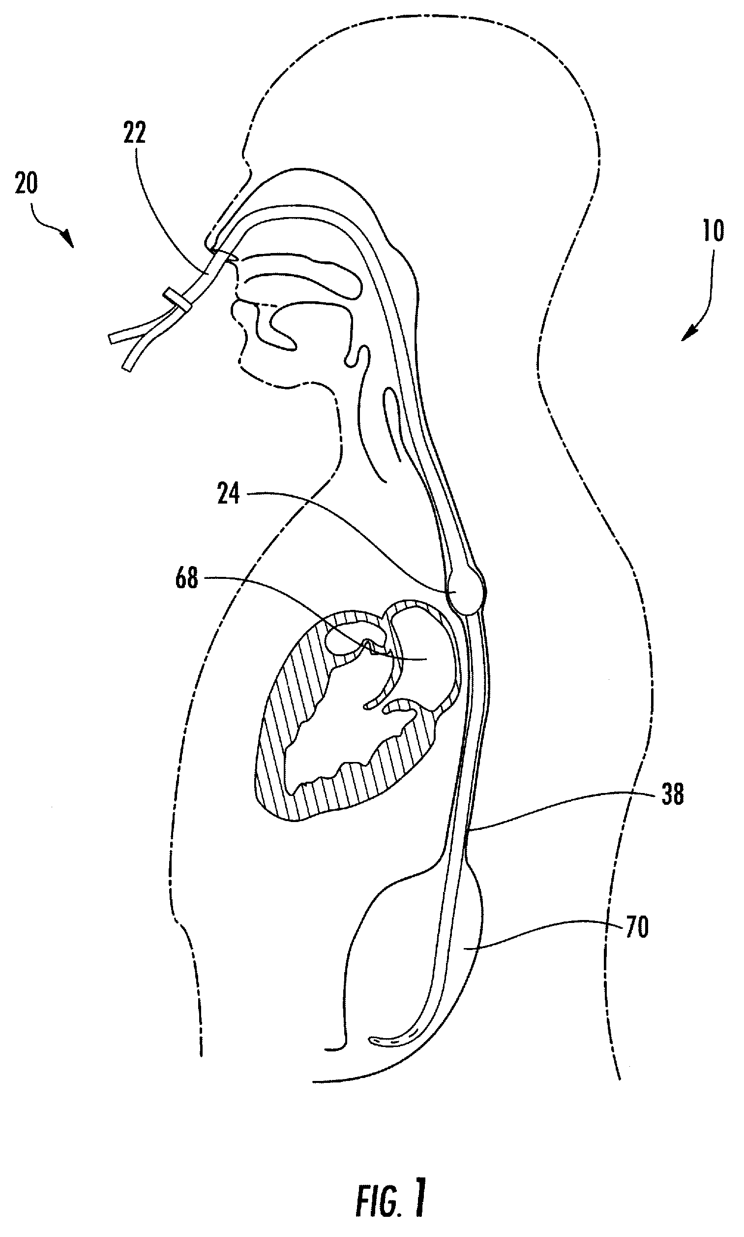Esophageal cooling system for ablation procedures associated with cardiac arrhythmias