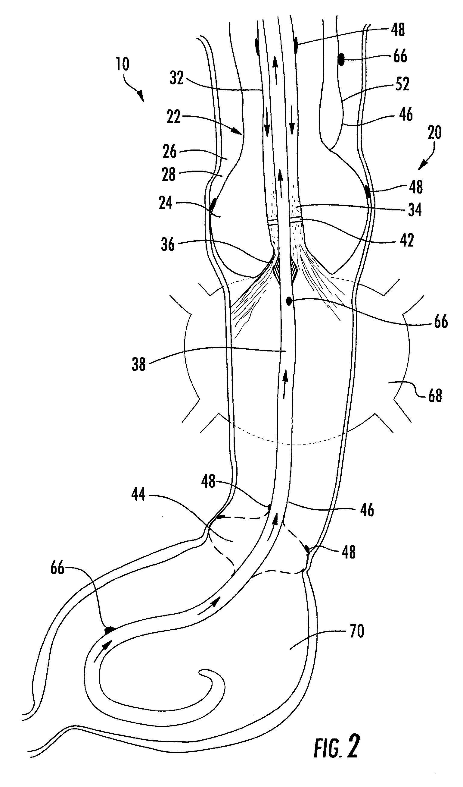 Esophageal cooling system for ablation procedures associated with cardiac arrhythmias