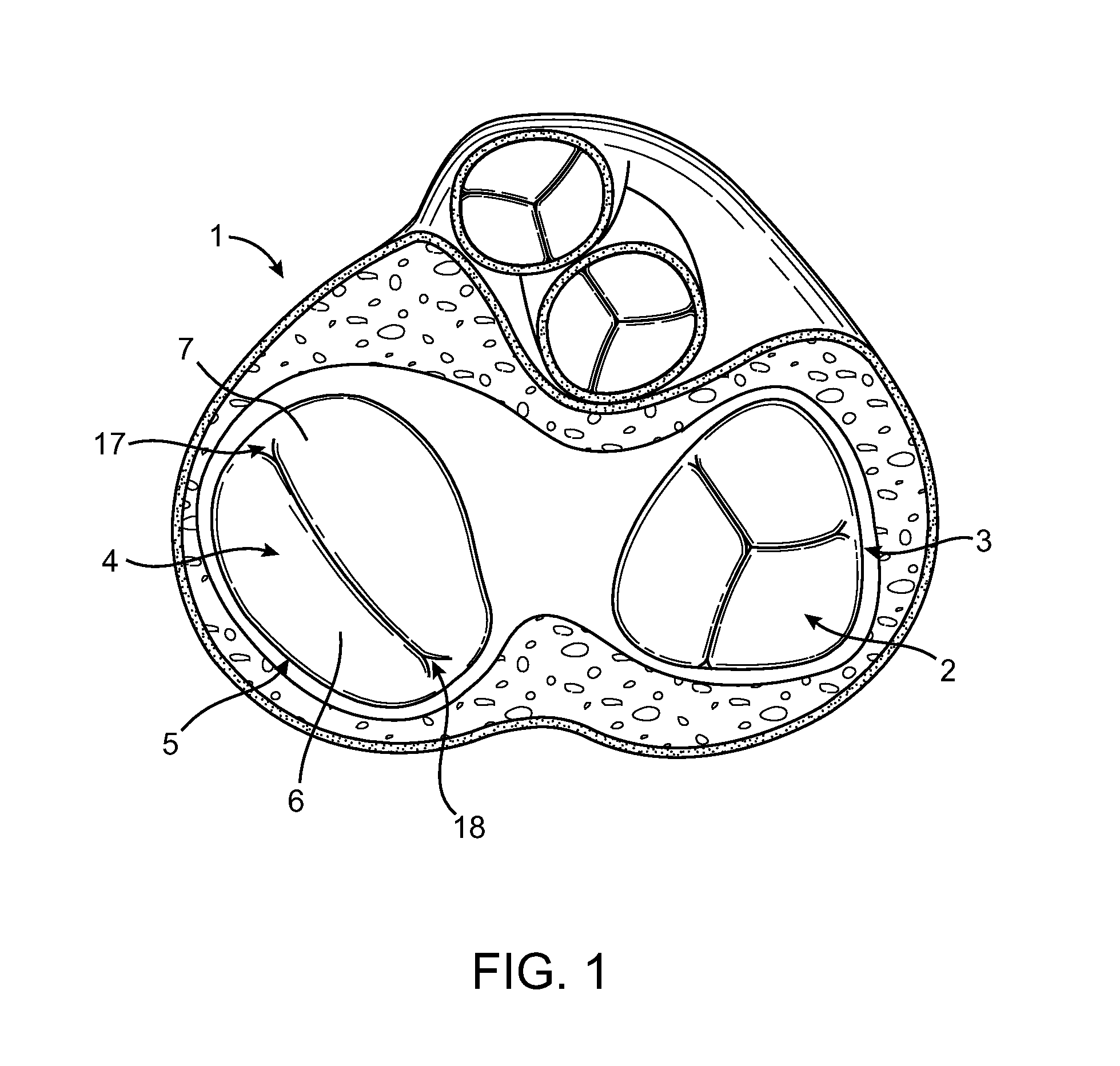 Annuloplasty Device Having a Helical Anchor and Methods for its Use