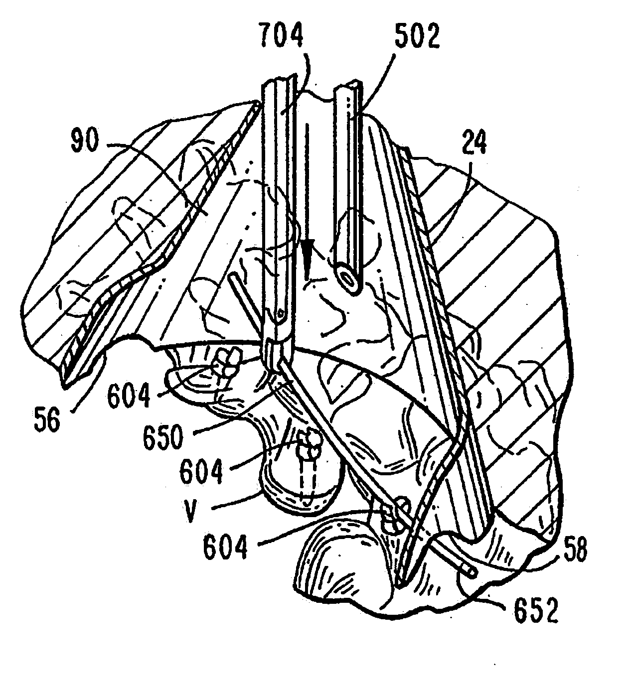 Methods and apparatuses for treating the spine through an access device