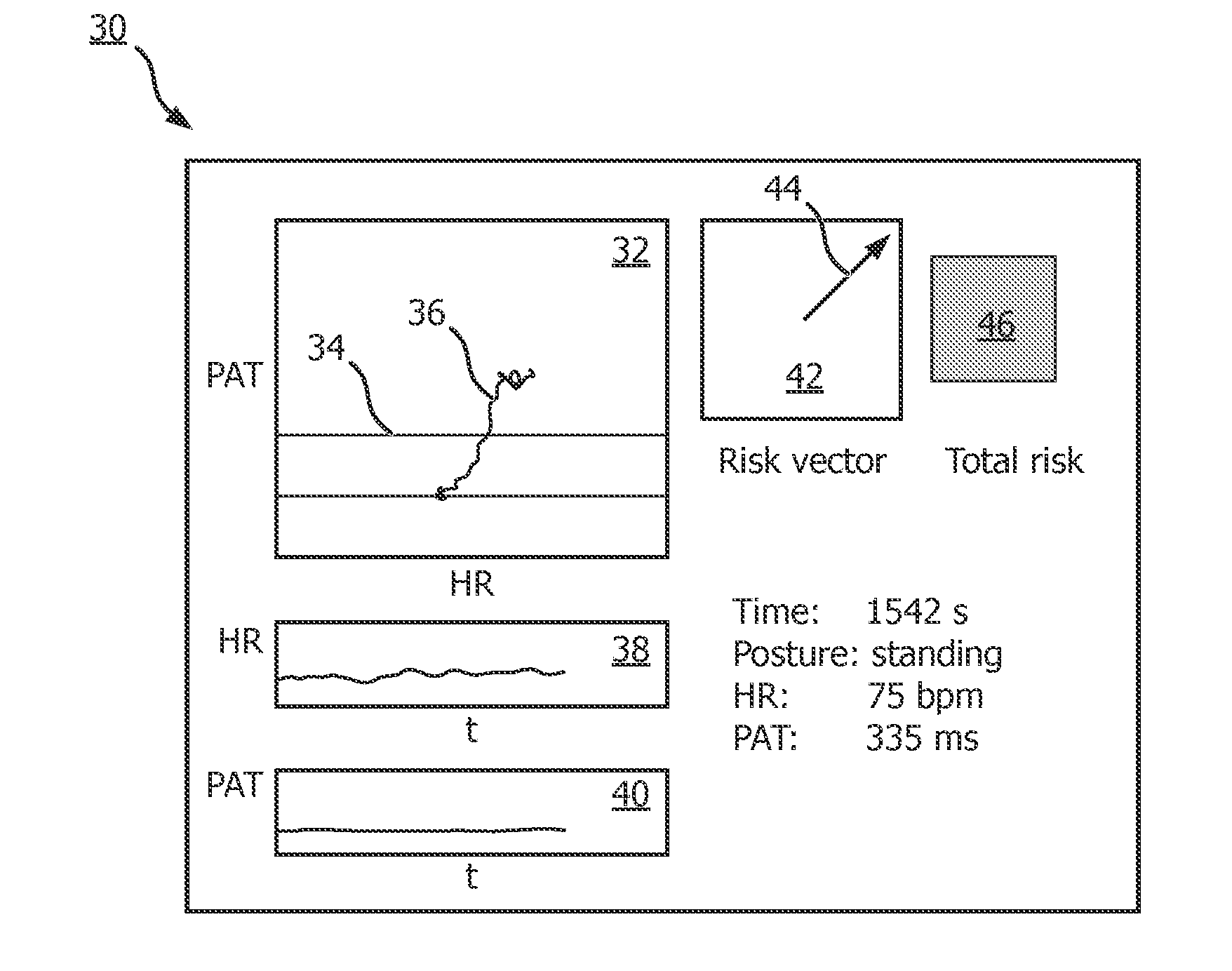 Method and device for detecting a critical hemodynamic event of a patient