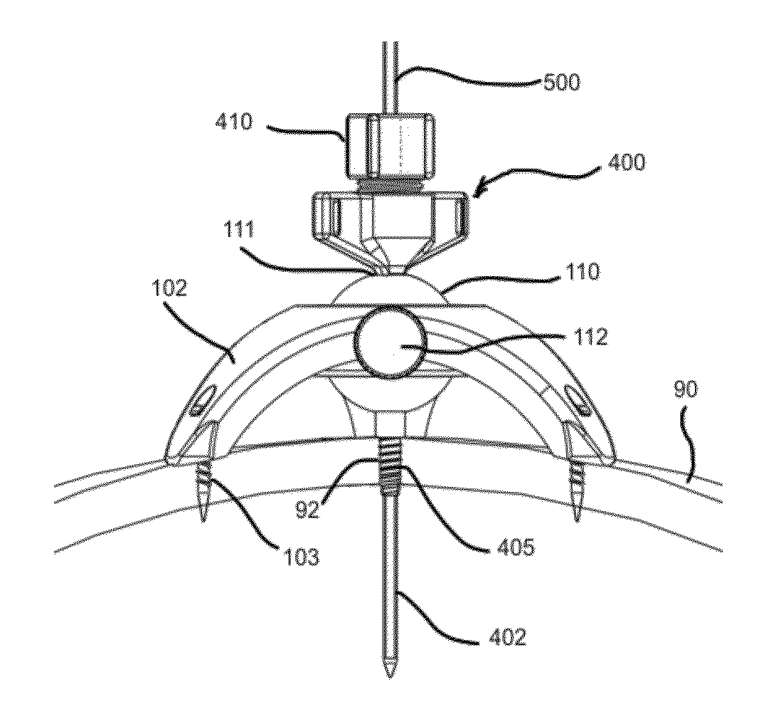 Stereotactic access devices and methods