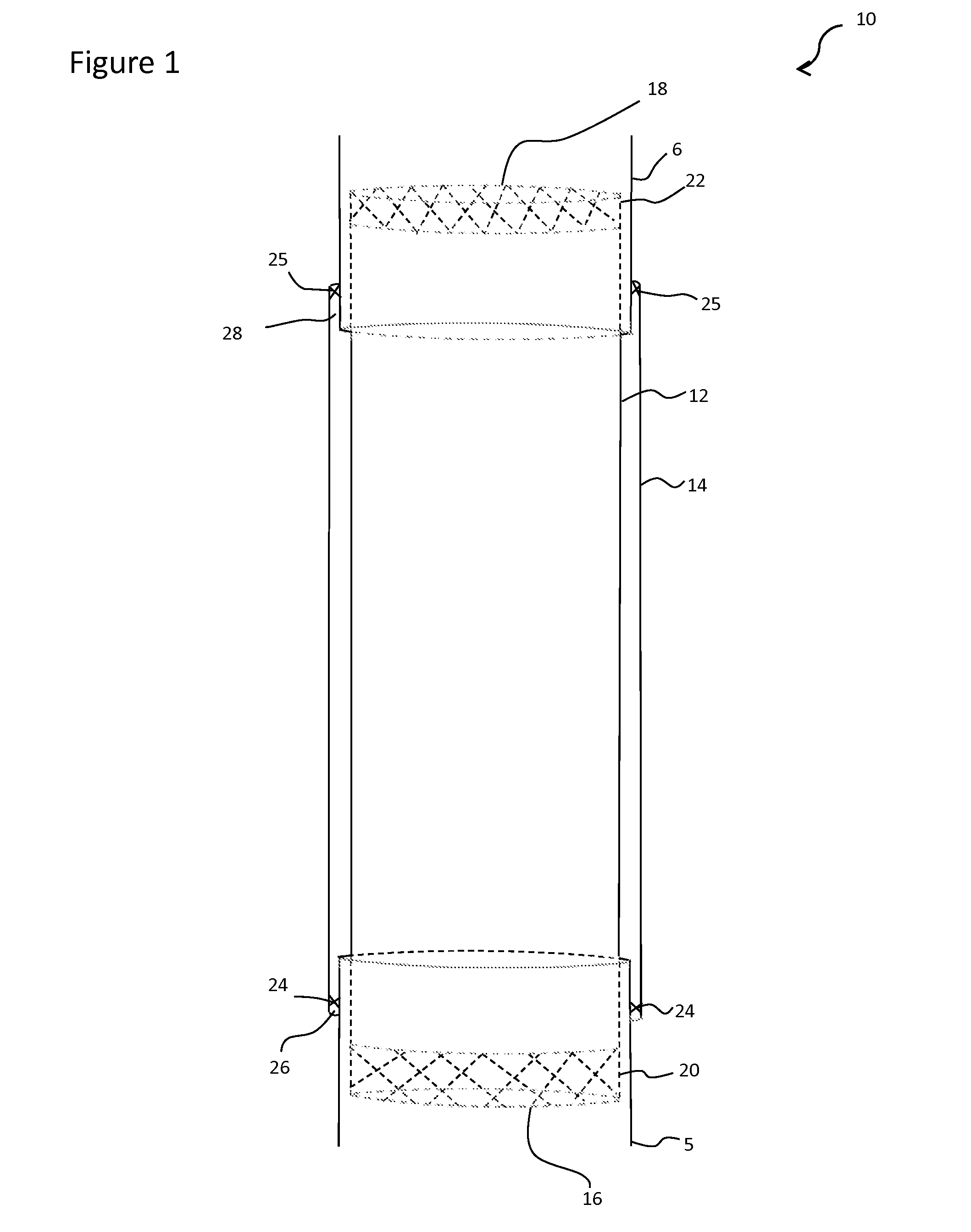 Methods and materials for replacing a circumferential segment of an esophagus