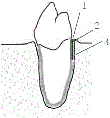 Biomimetic layered stent for periodontal tissue defect repair and preparation method thereof