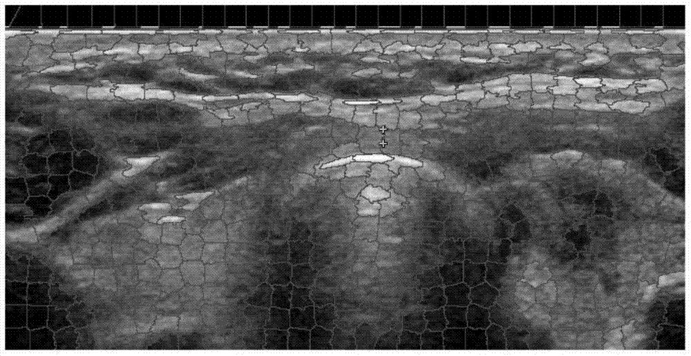 An image recognition method for thyroid lesions based on low-rank analysis of ultrasound images