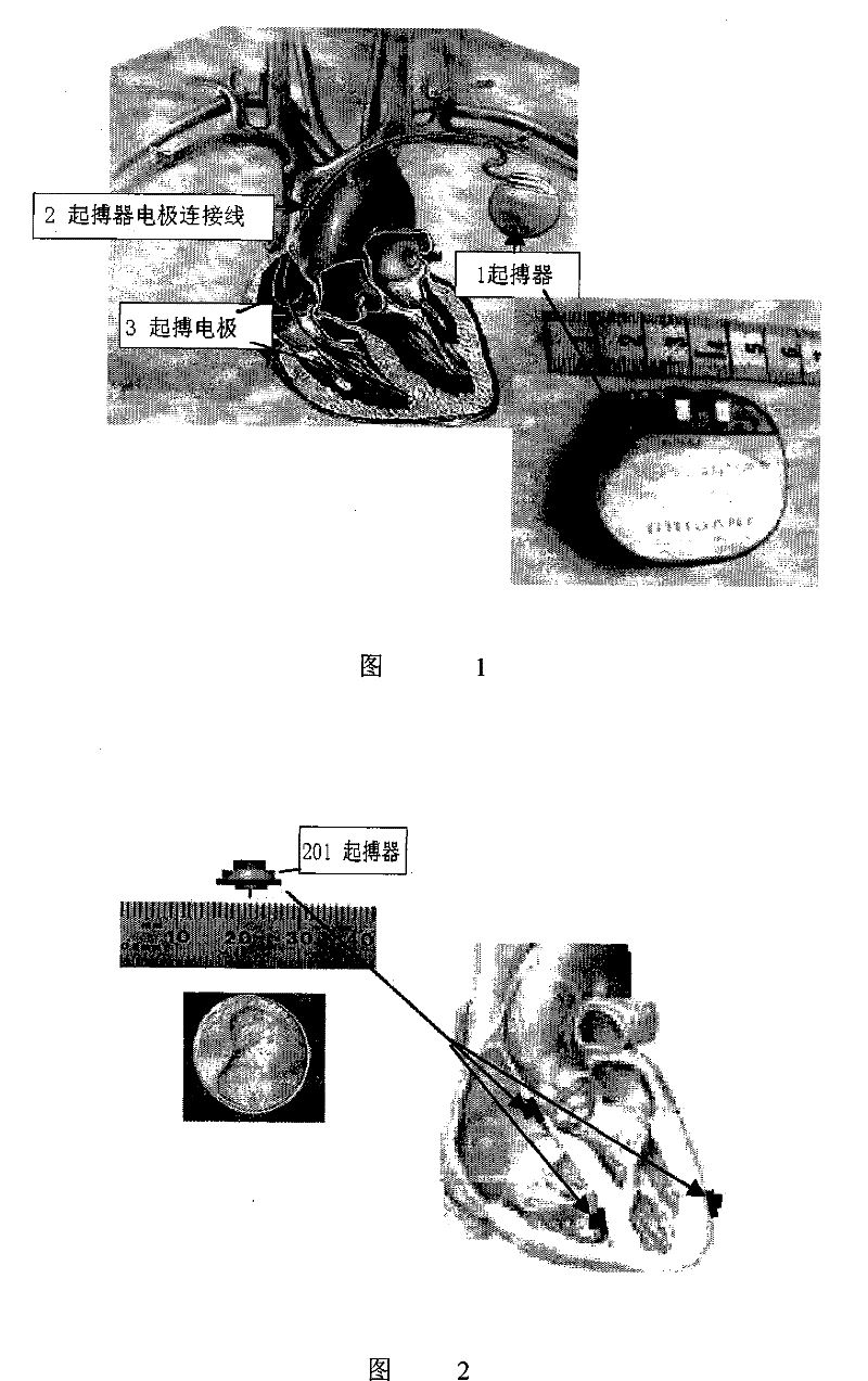 No-electrode ultrathin minitype multifunctional heart rhythm regulation and control device