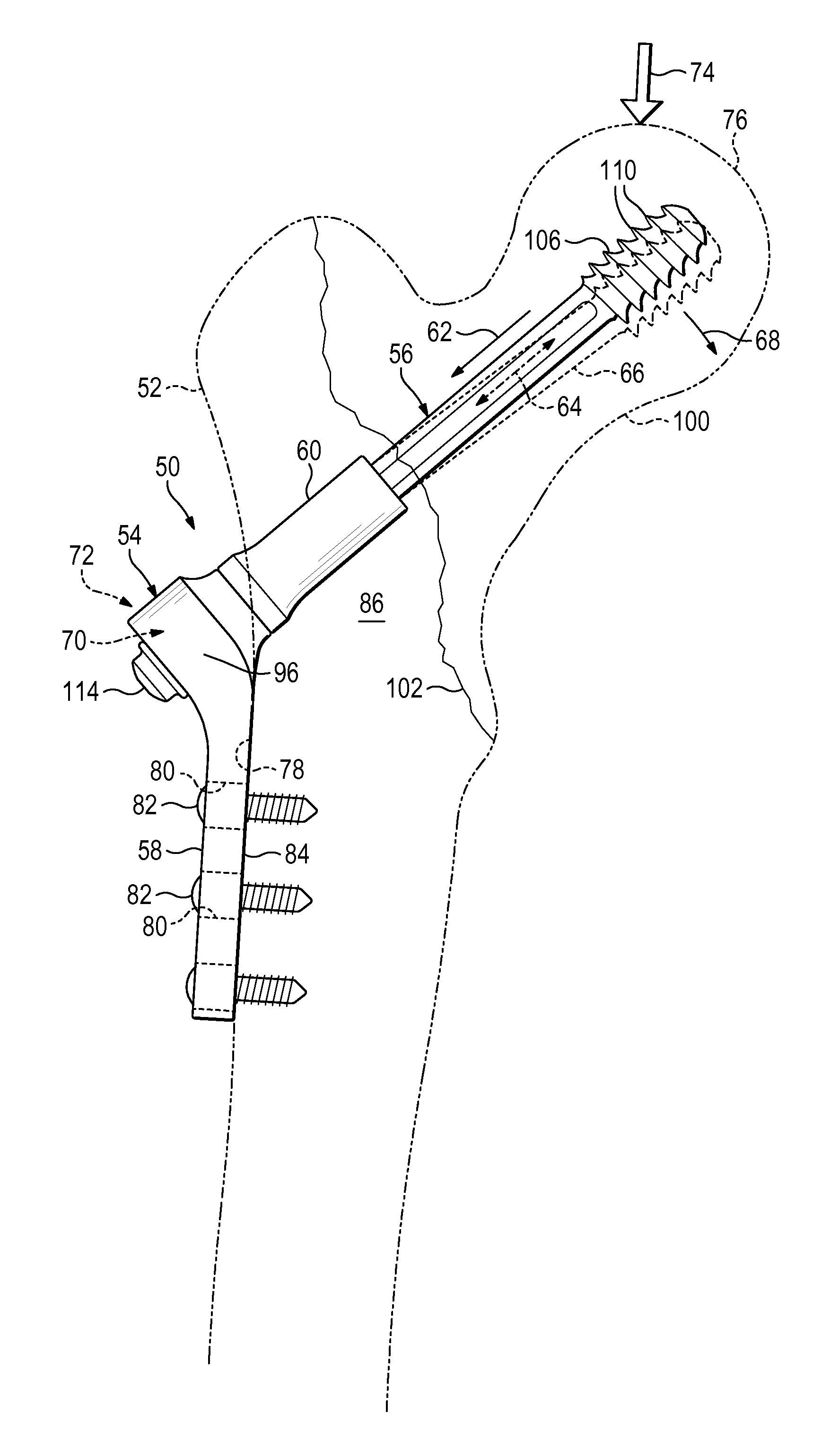 Plate-based compliant hip fixation system