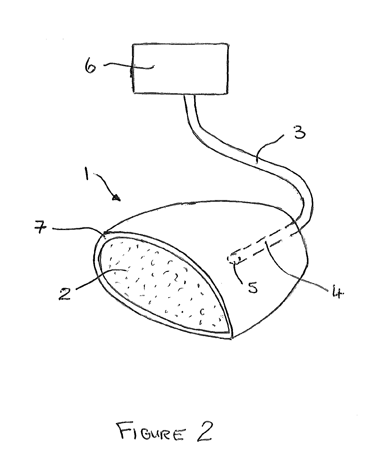 Method of moulding and a core plug for use in the method