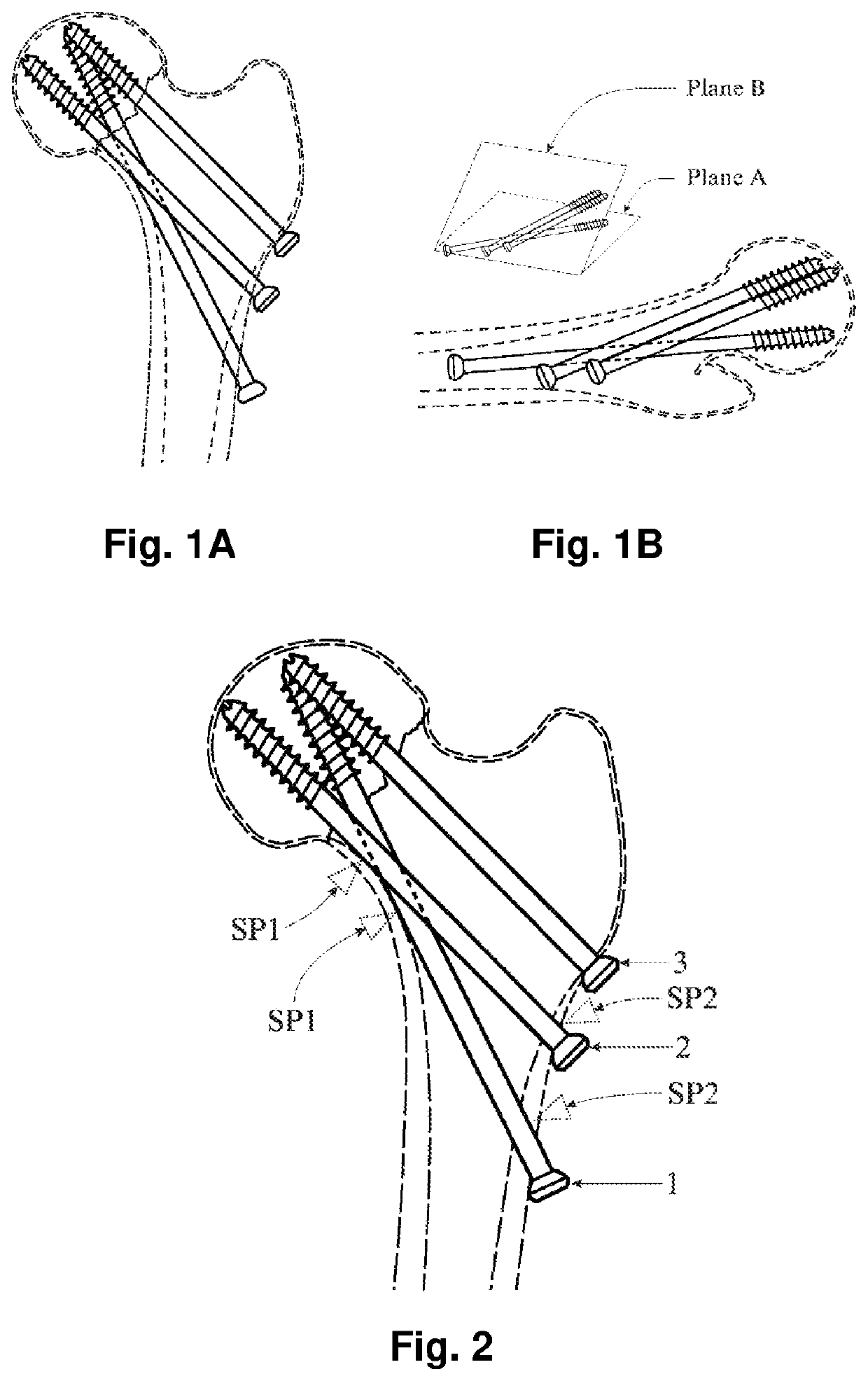 Surgical method for biplane screw fixation of femoral neck fractures (calcar buttressed screw fixation)