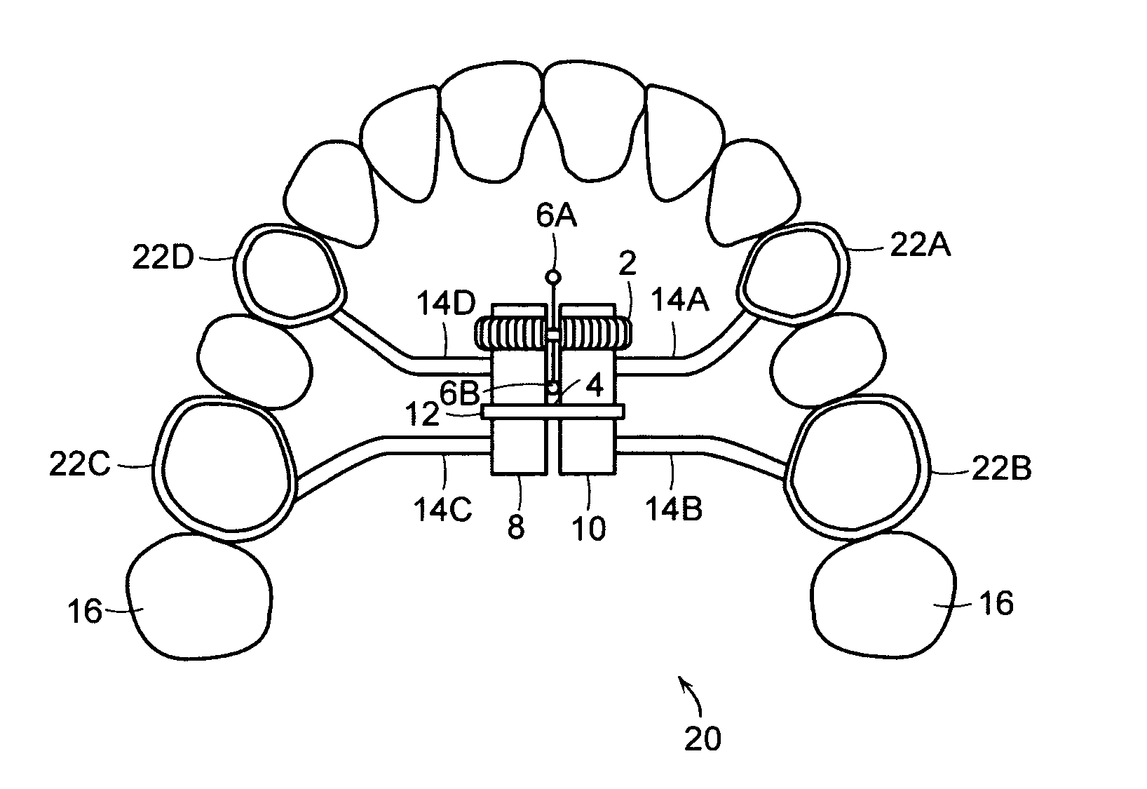 Palatal expansion device and methods