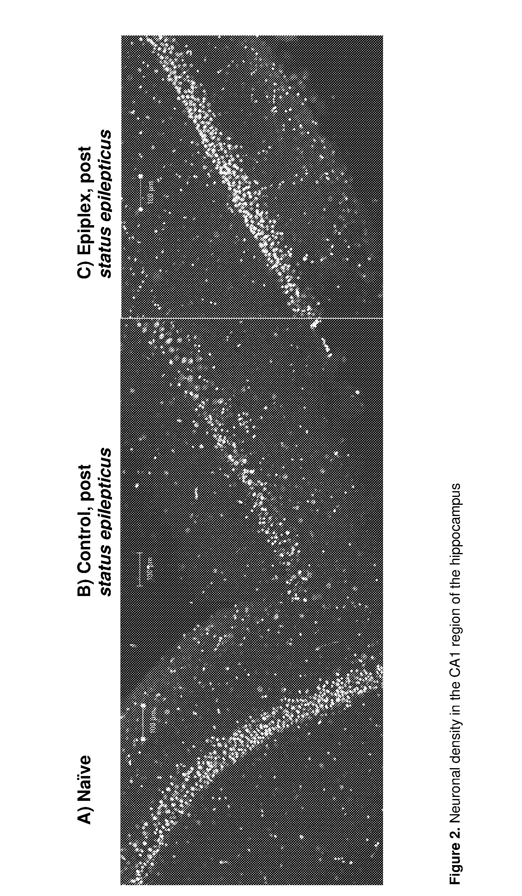 Reduction of epileptic seizures