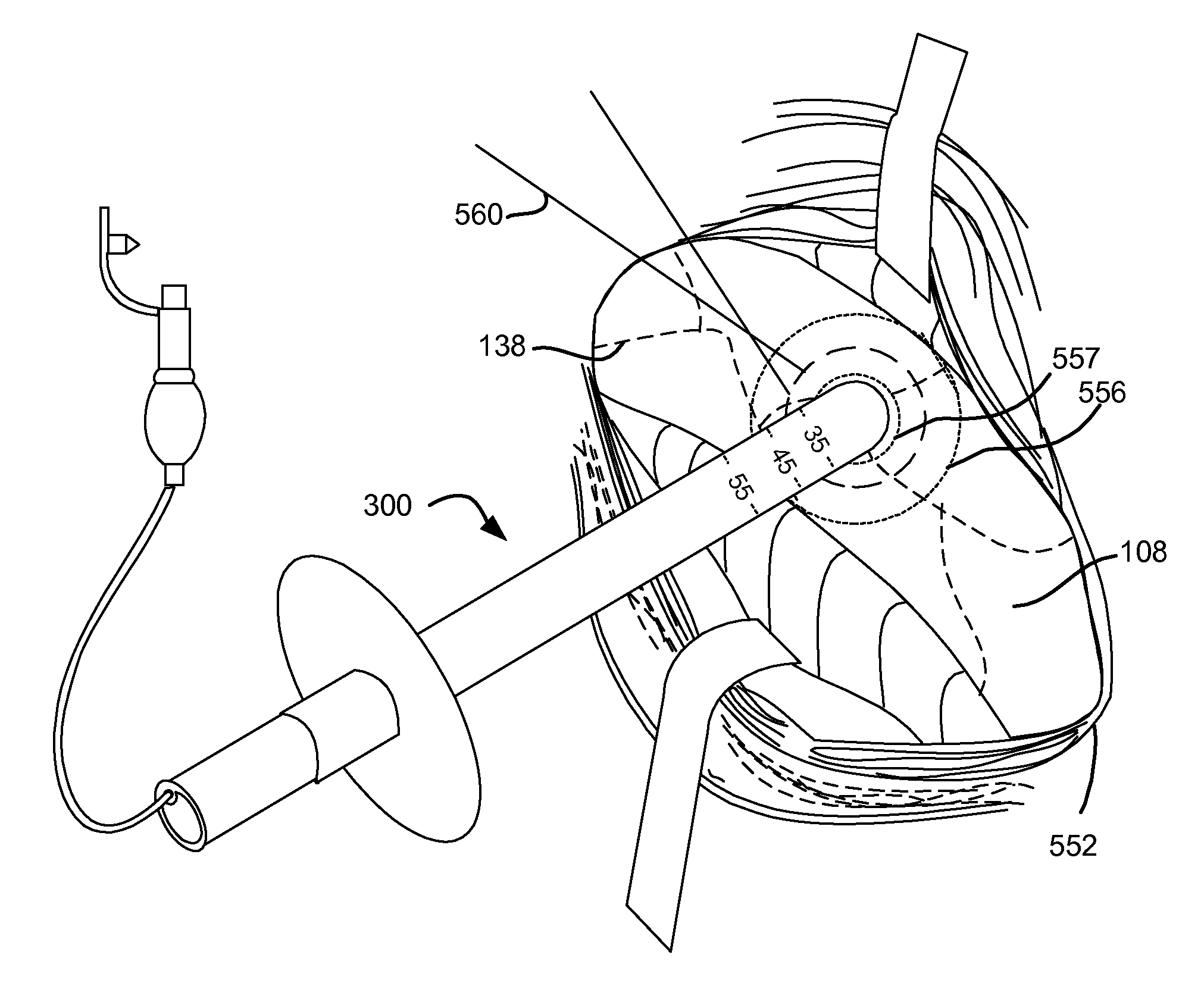 Single-phase surgical procedure for creating a pneumostoma to treat chronic obstructive pulmonary disease