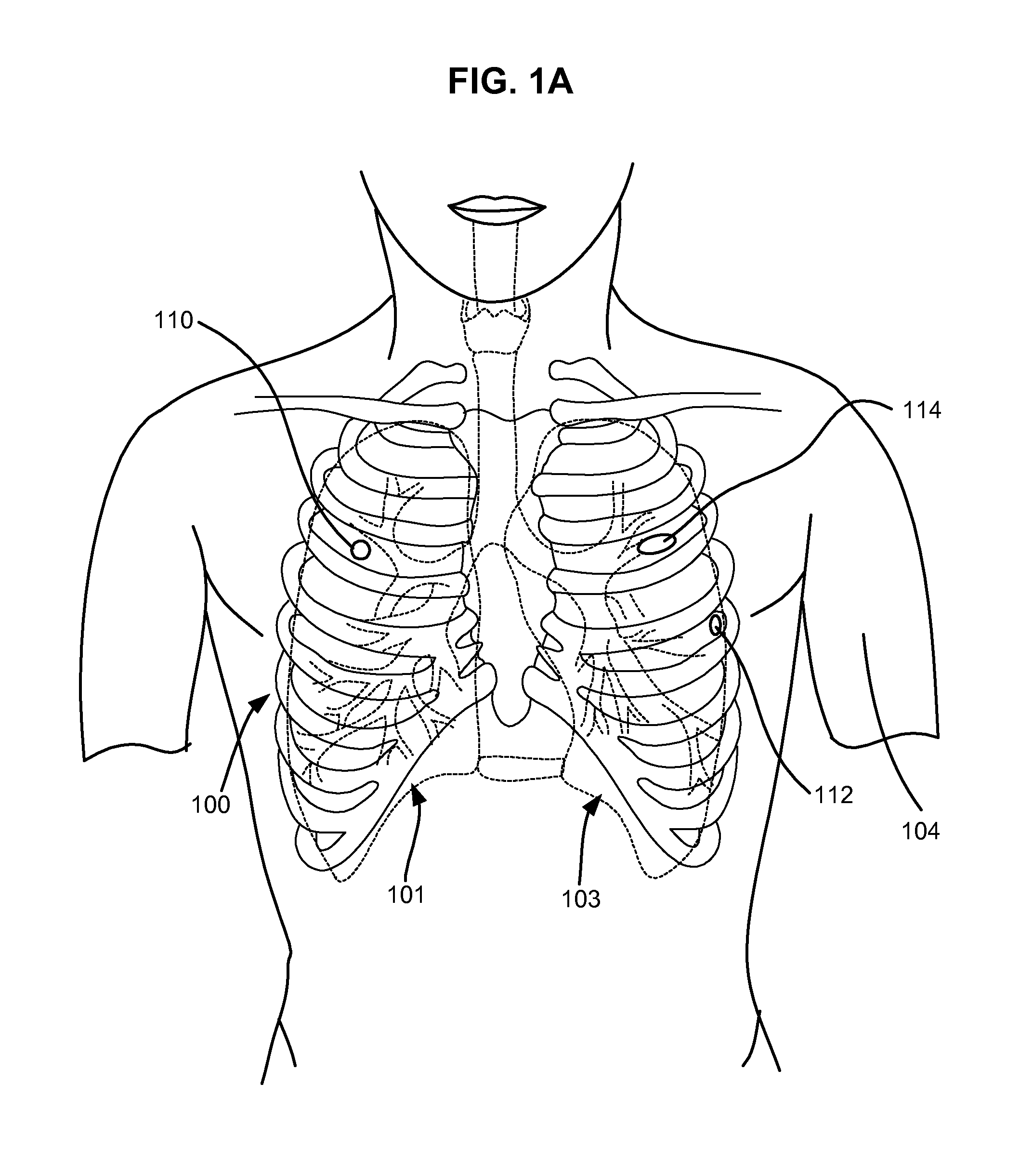 Single-phase surgical procedure for creating a pneumostoma to treat chronic obstructive pulmonary disease