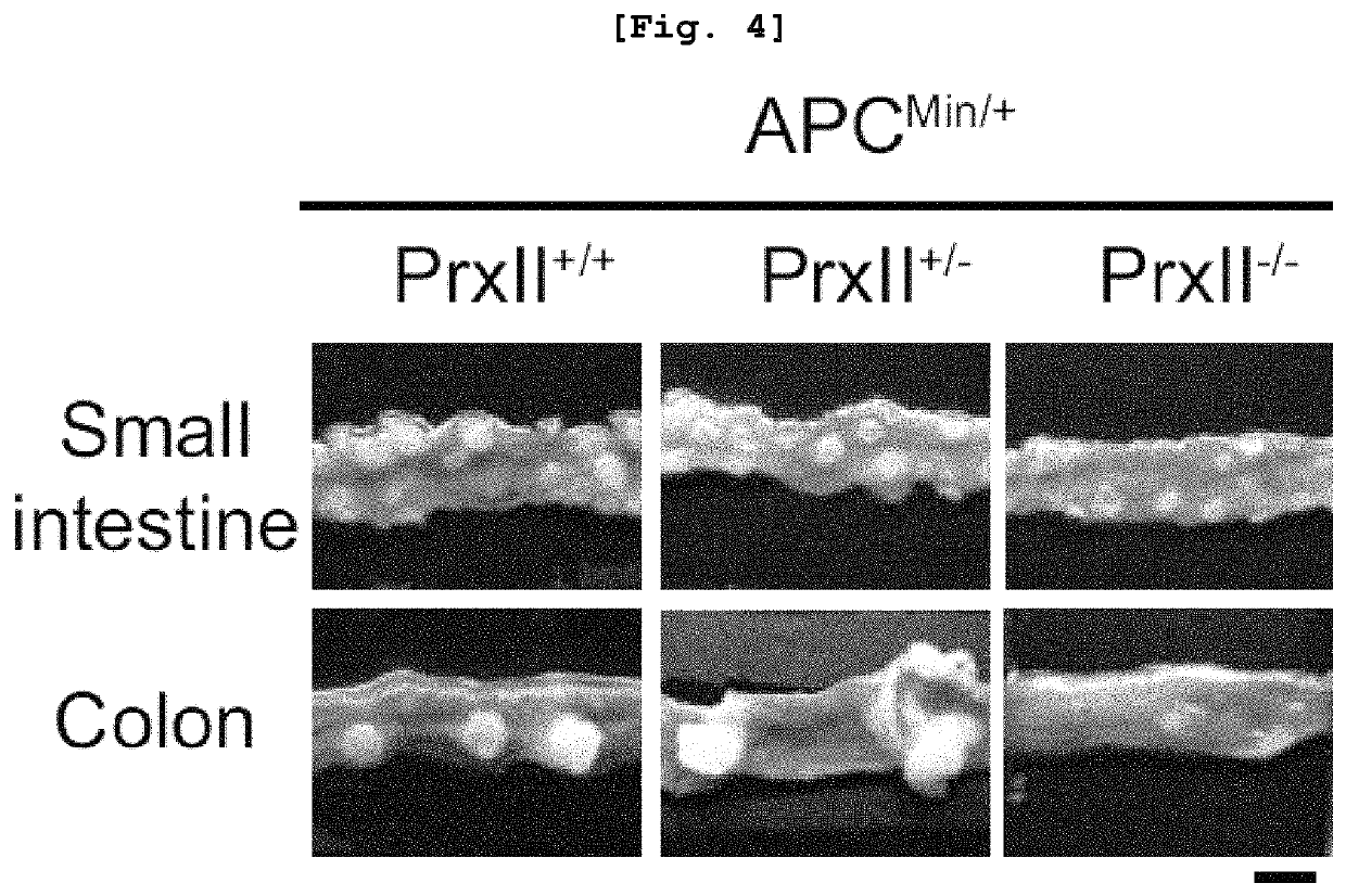 Pharmaceutical composition comprising substance inhibiting enzymatic activity of peroxiredoxin 2 as effective ingredient for treatment of colorectal cancer