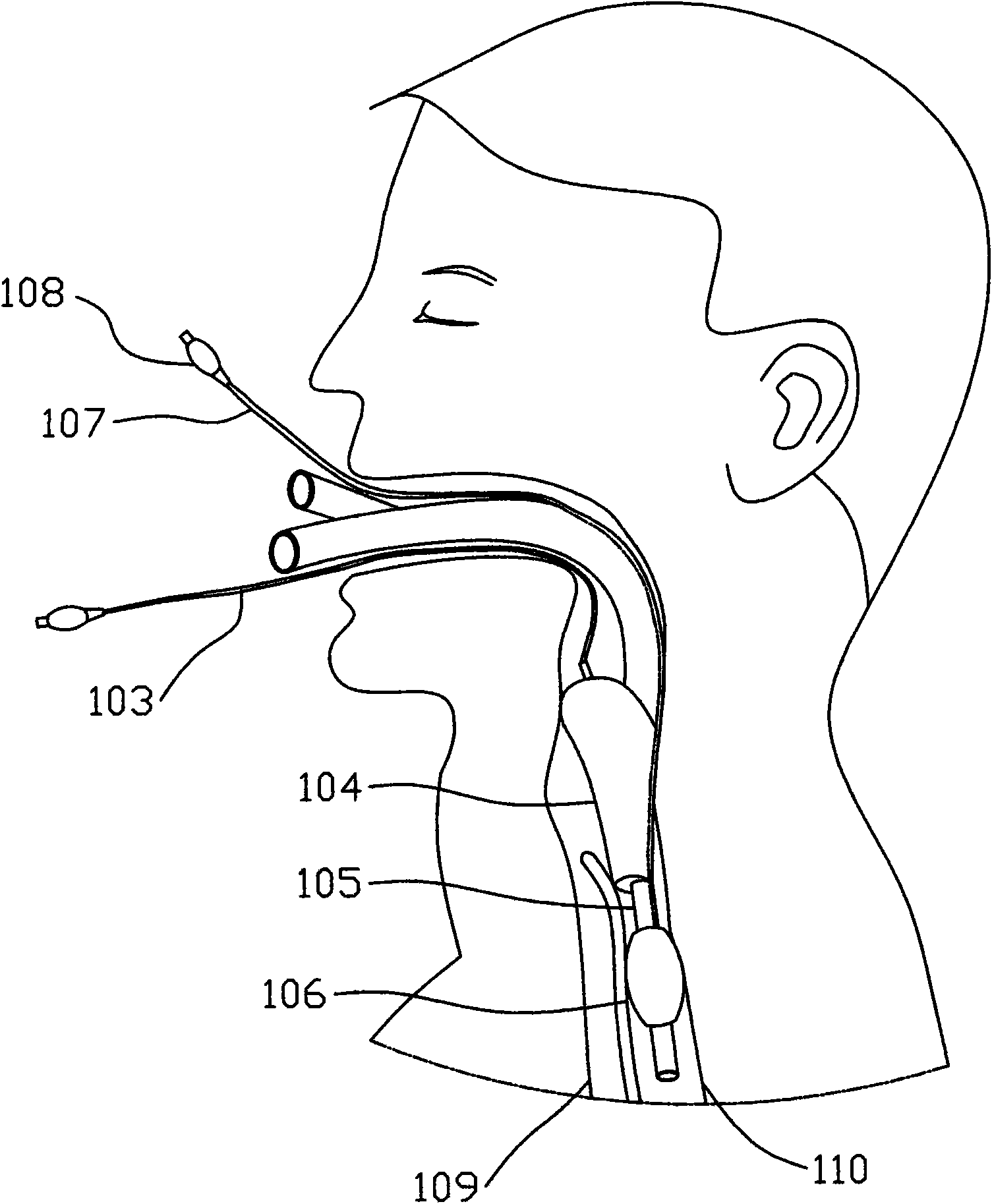 Laryngeal mask for esophageal blockage