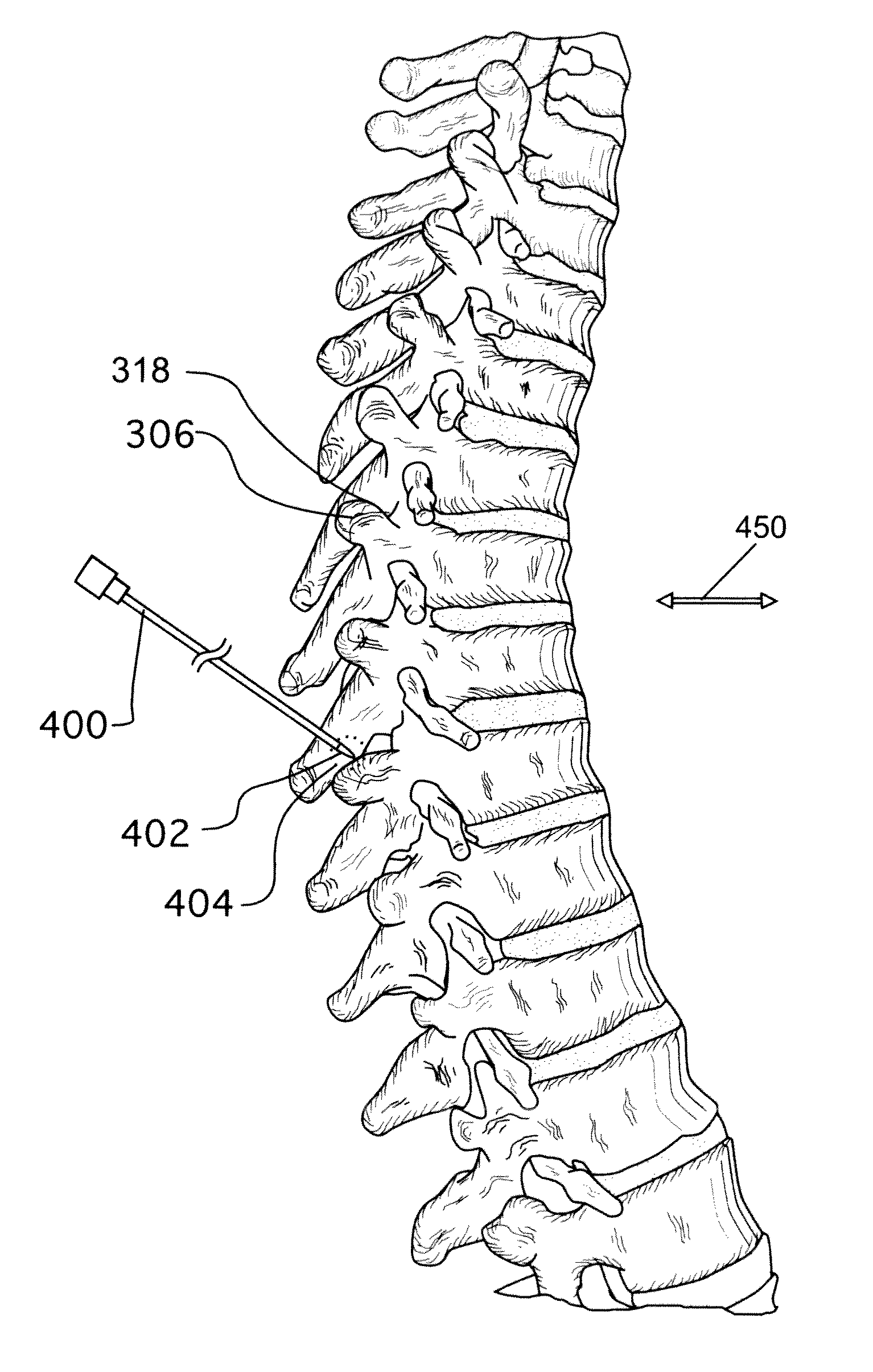 Methods for treating the thoracic region of a patient's body