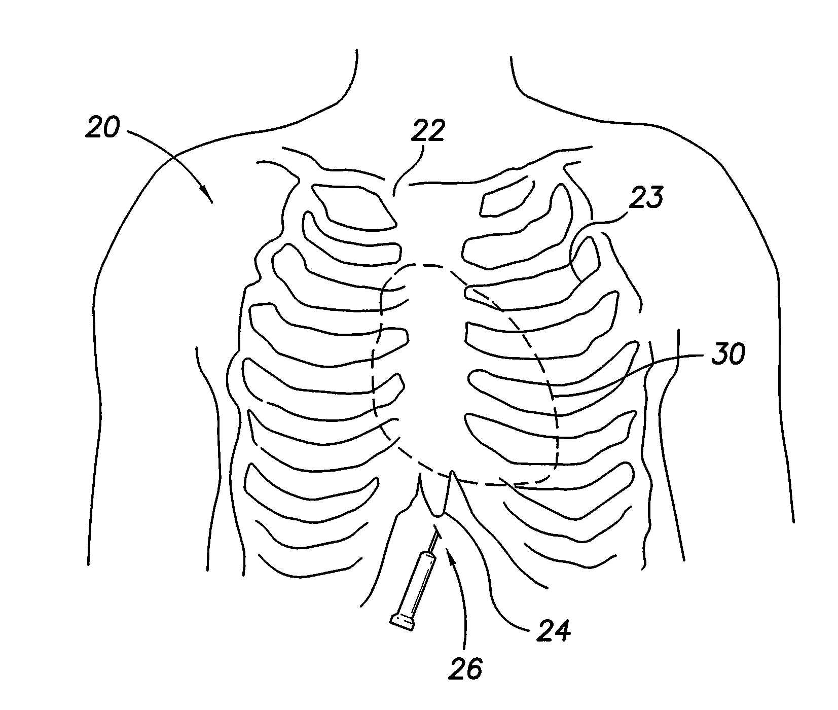 Intra-pericardial medical device
