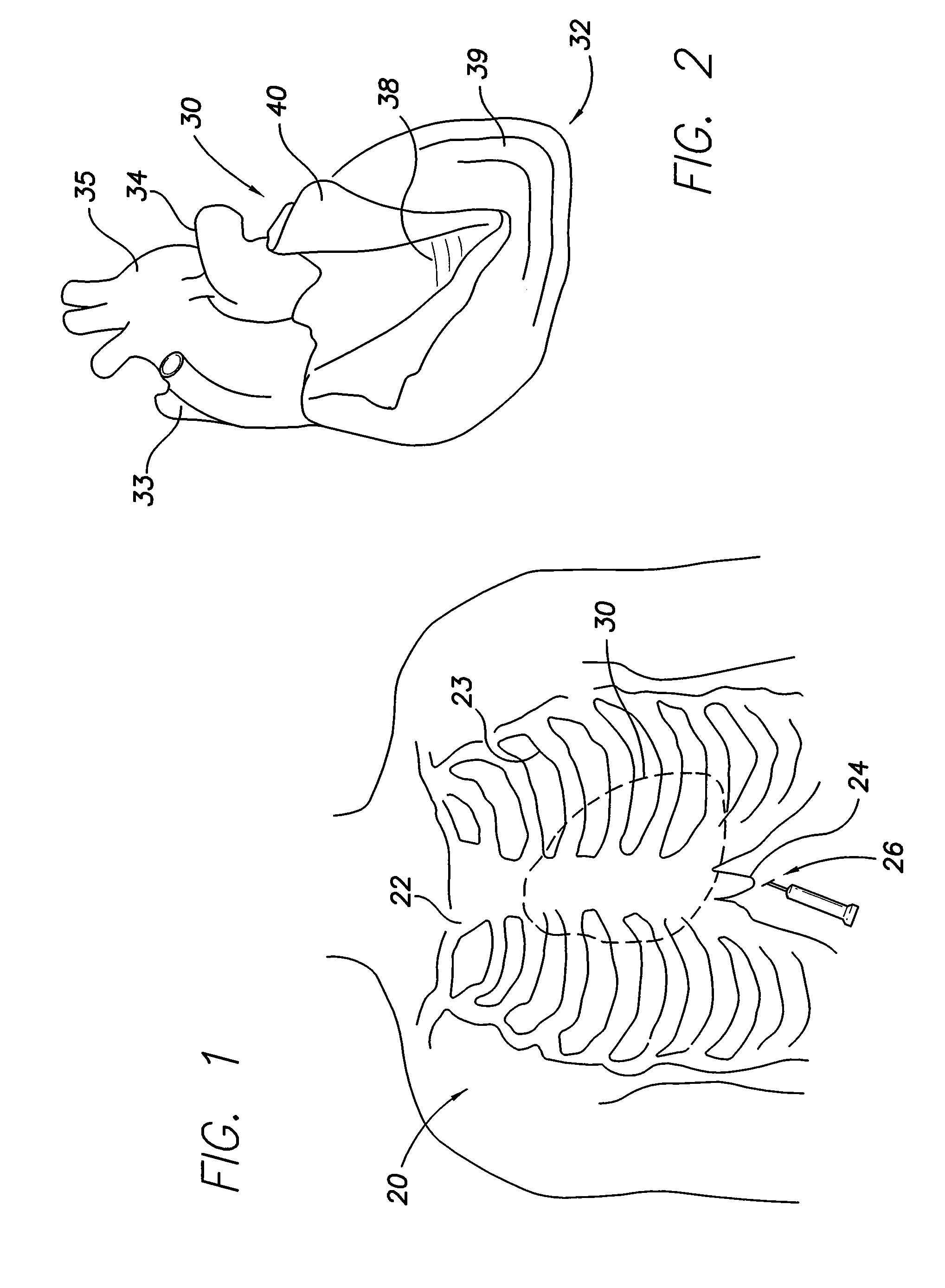 Intra-pericardial medical device
