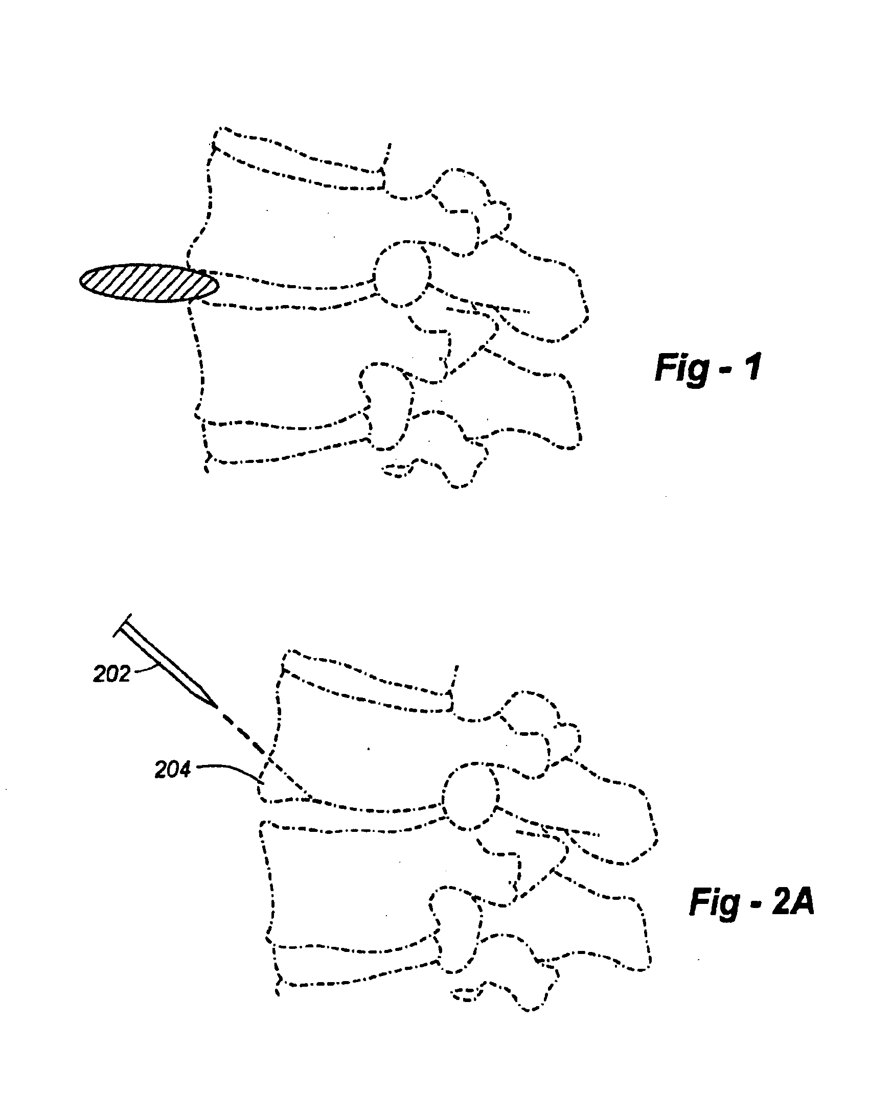 Methods and apparatus for placing intradiscal devices