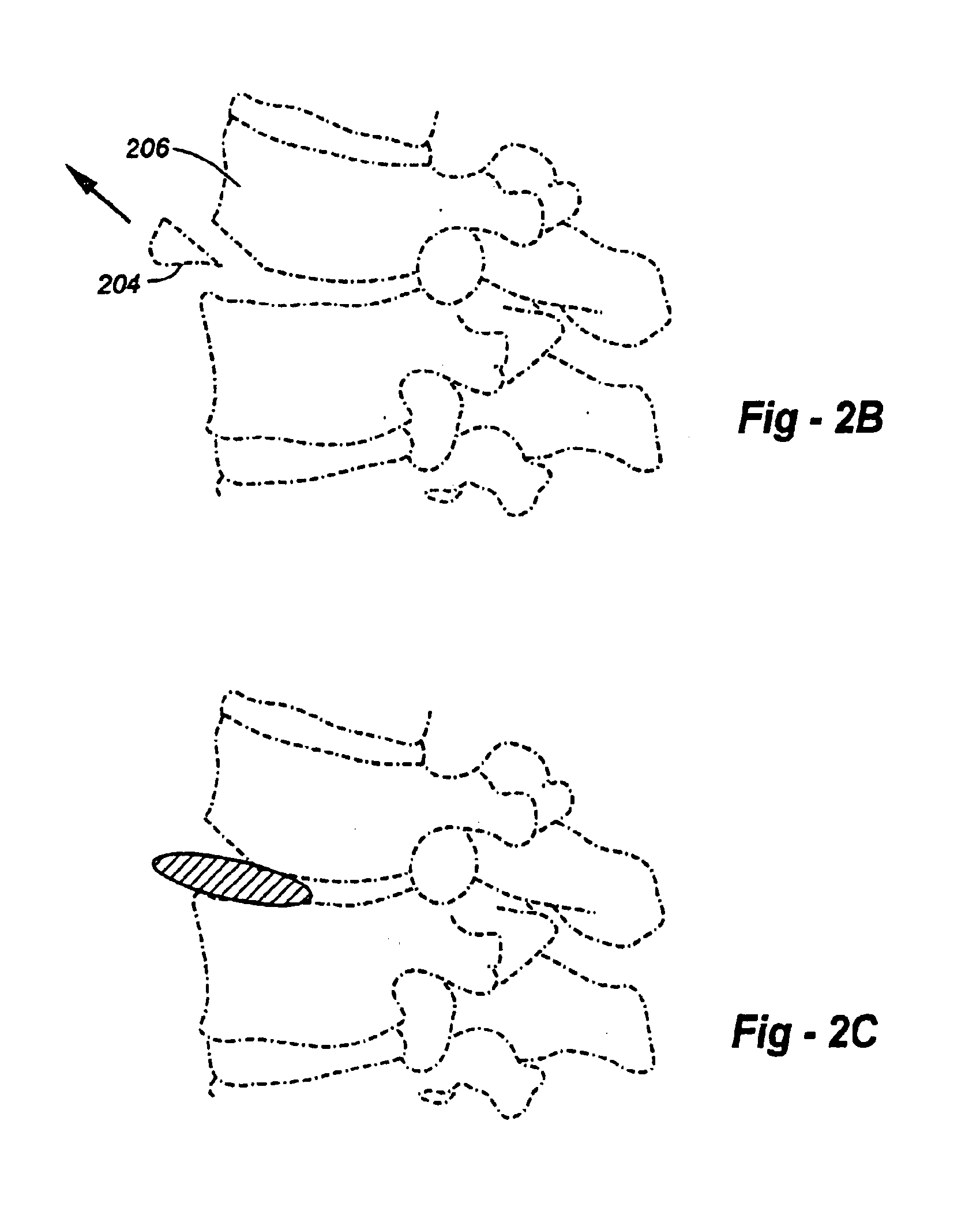 Methods and apparatus for placing intradiscal devices