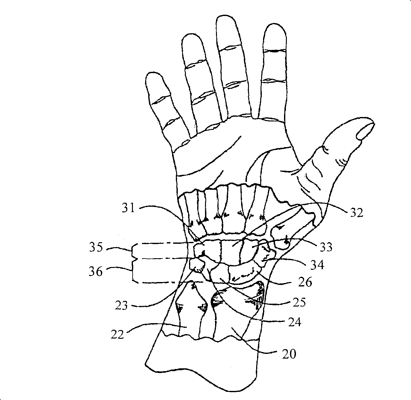 Improved orthotic appliance for carpal tunnel syndrome