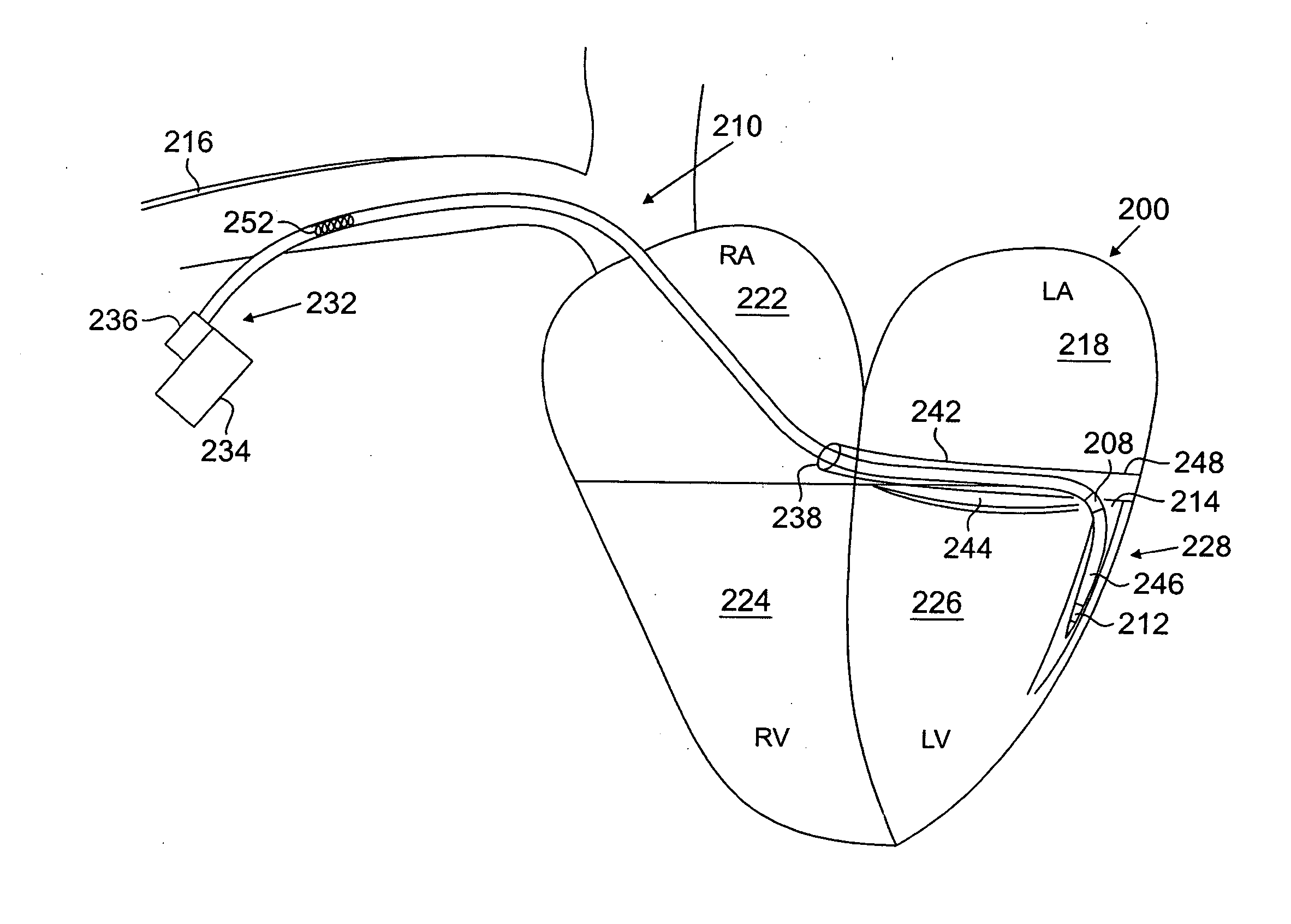 Devices and methods for accelerometer-based characterization of cardiac synchrony and dyssynchrony