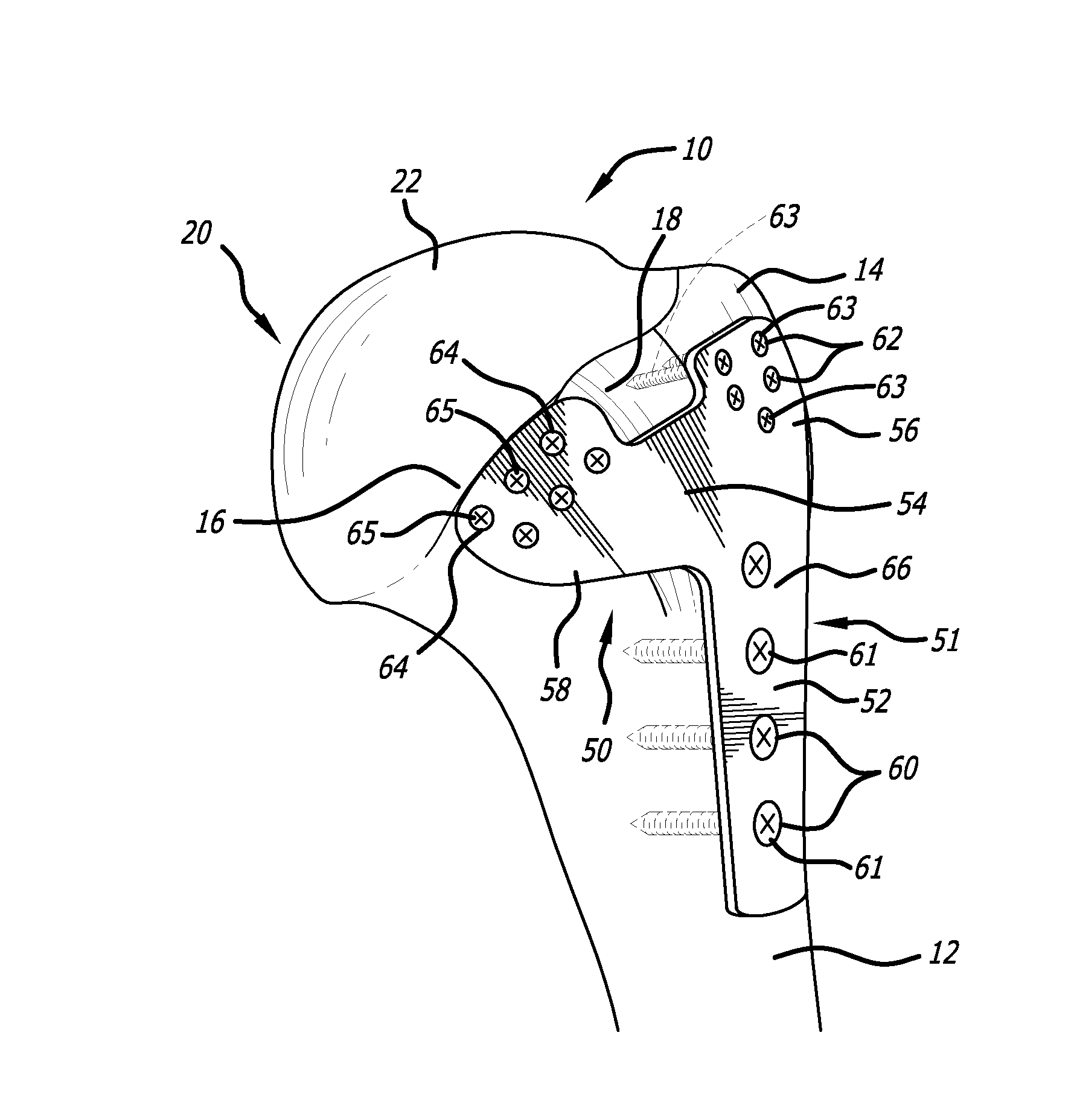 Anterior lesser tuberosity fixed angle fixation device and method of use associated therewith