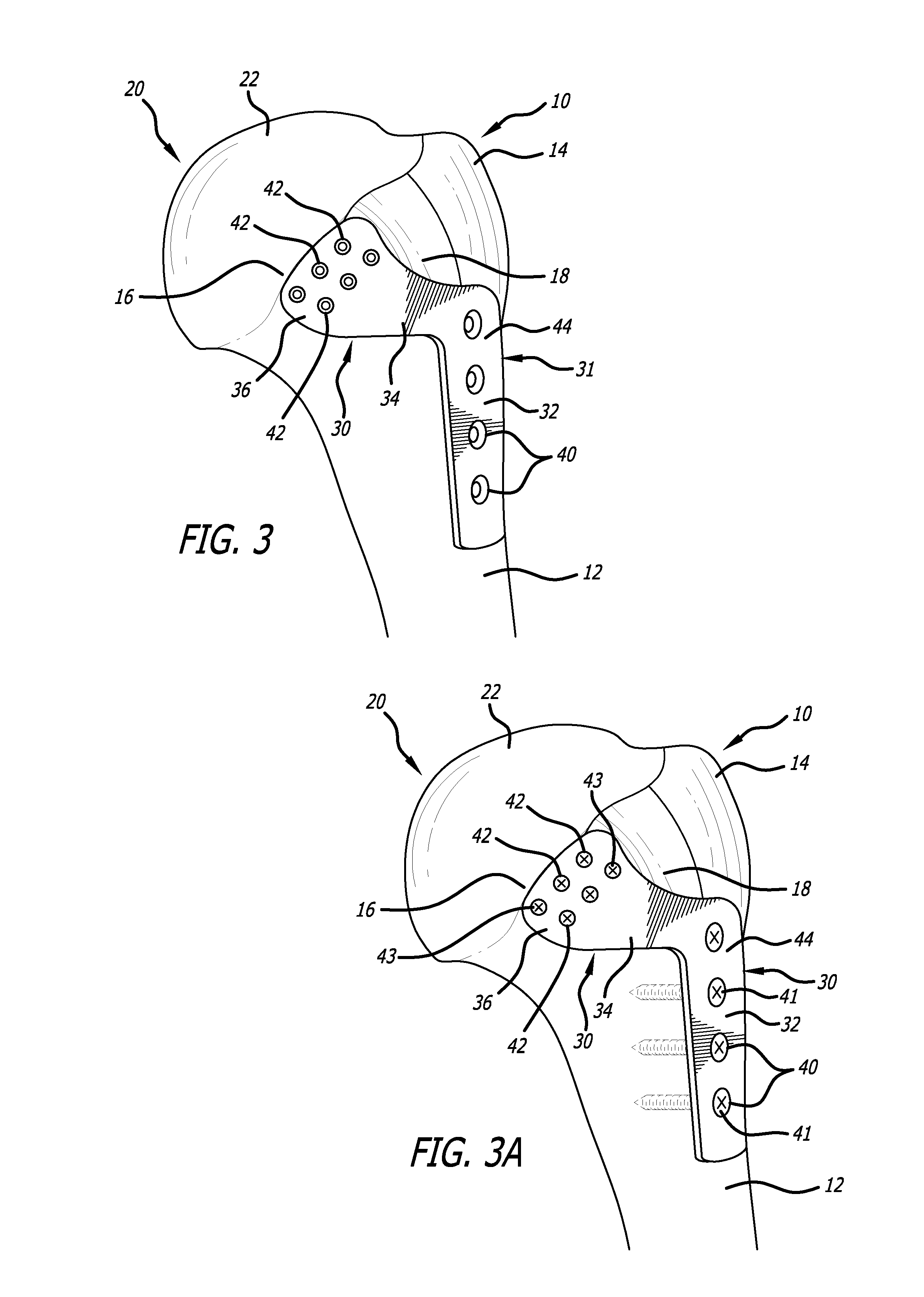 Anterior lesser tuberosity fixed angle fixation device and method of use associated therewith