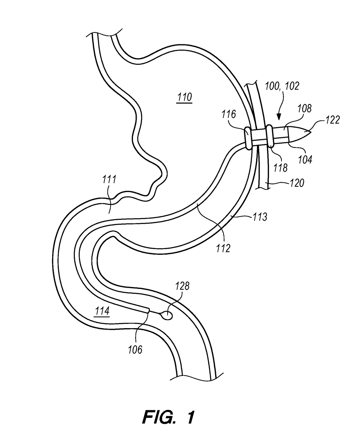 Double Lumen Integrated Enteral Feeding Assembly and a Method for Use Thereof