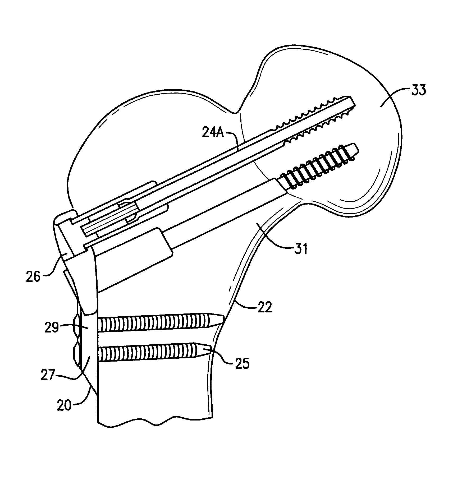 Hip fracture device with static locking mechanism allowing compression