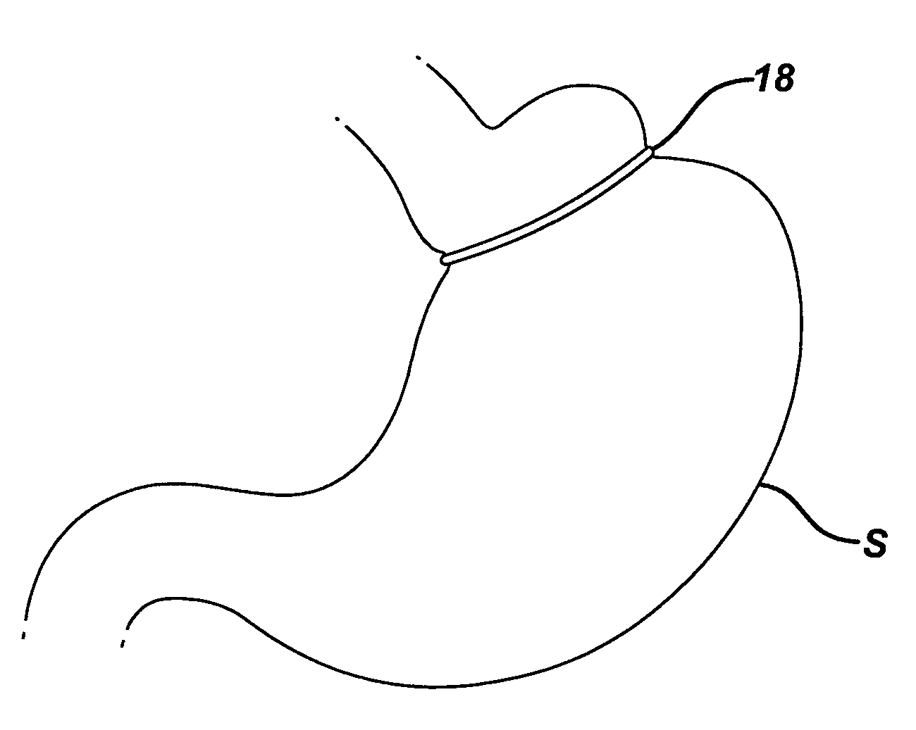 Methods and devices for placement of an intra-abdominal or intra-thoracic appliance through a natural body orifice