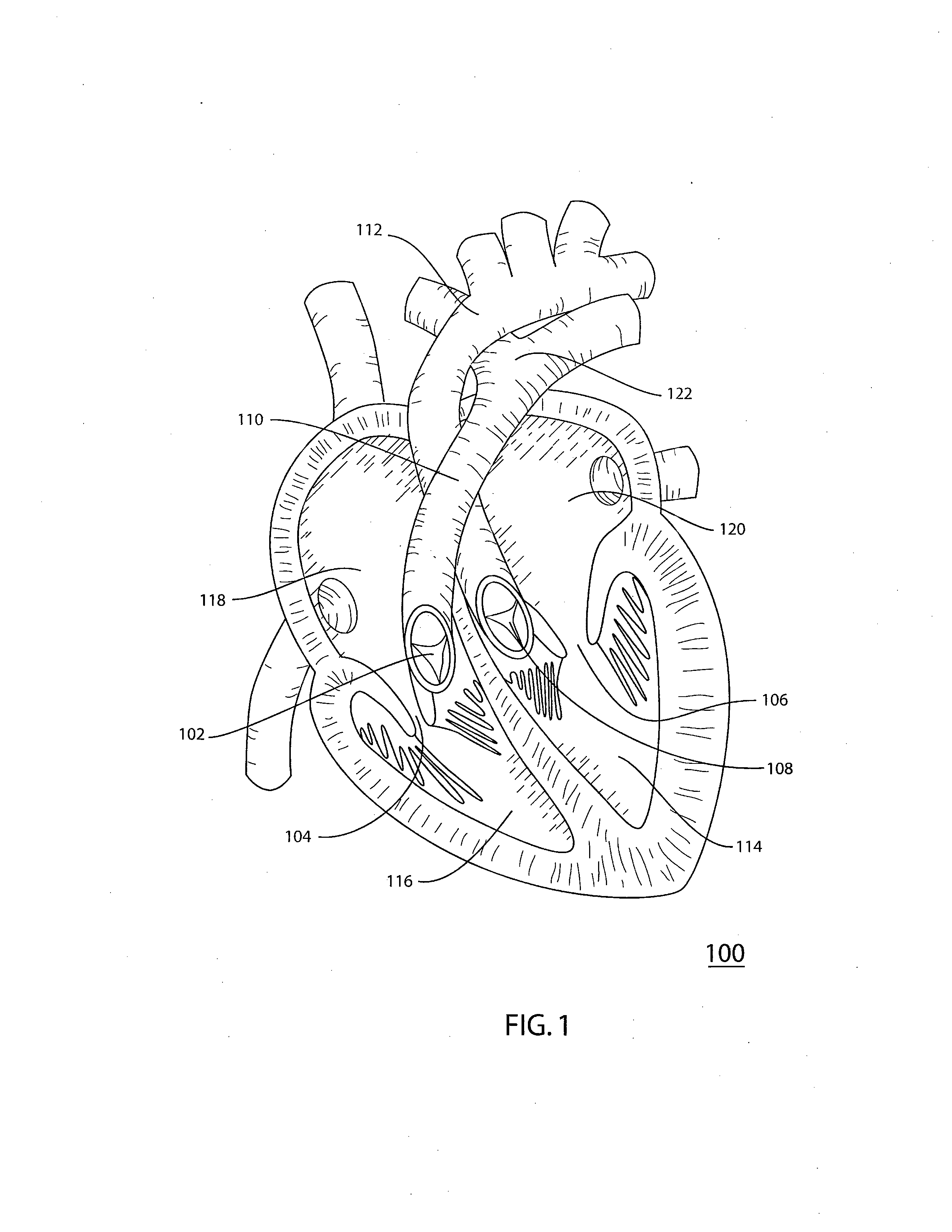 Stent Foundation for Placement of a Stented Valve
