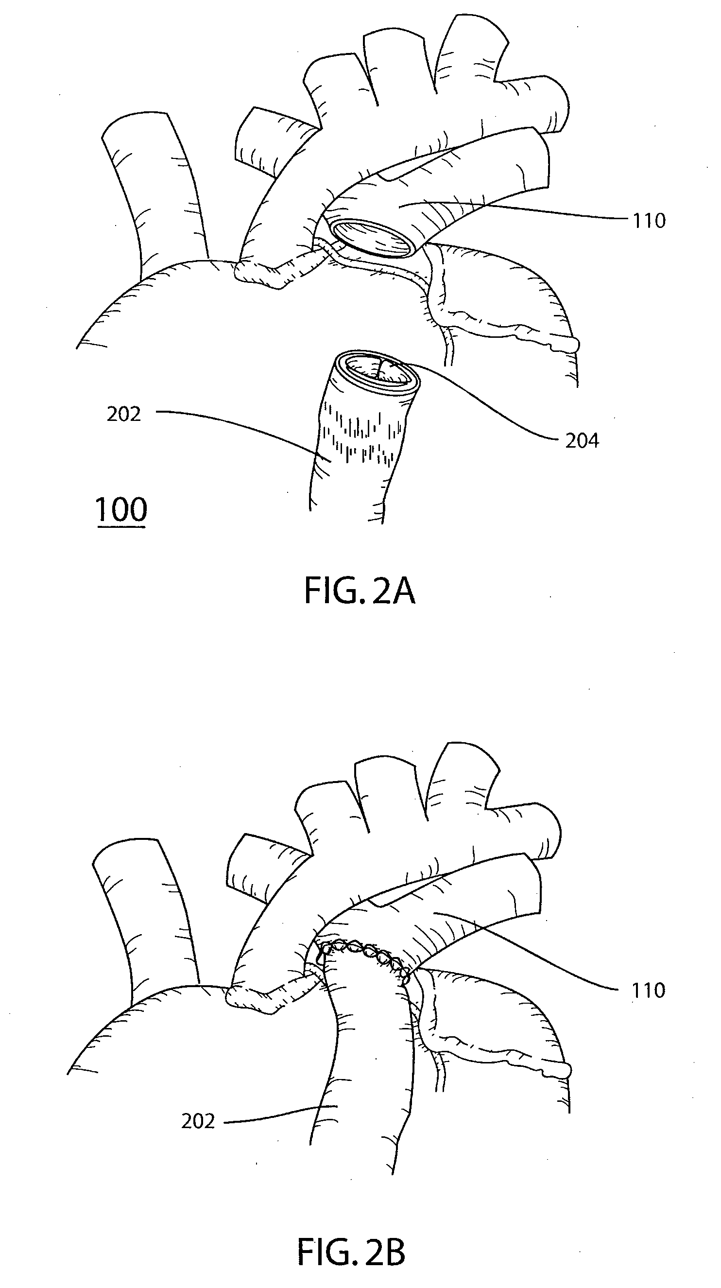 Stent Foundation for Placement of a Stented Valve