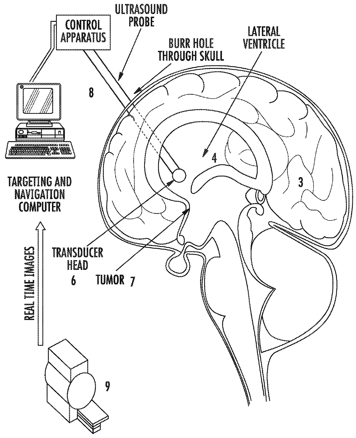 Minimally Invasive Focused Ultrasound (MIFUS) for Brain Surgery