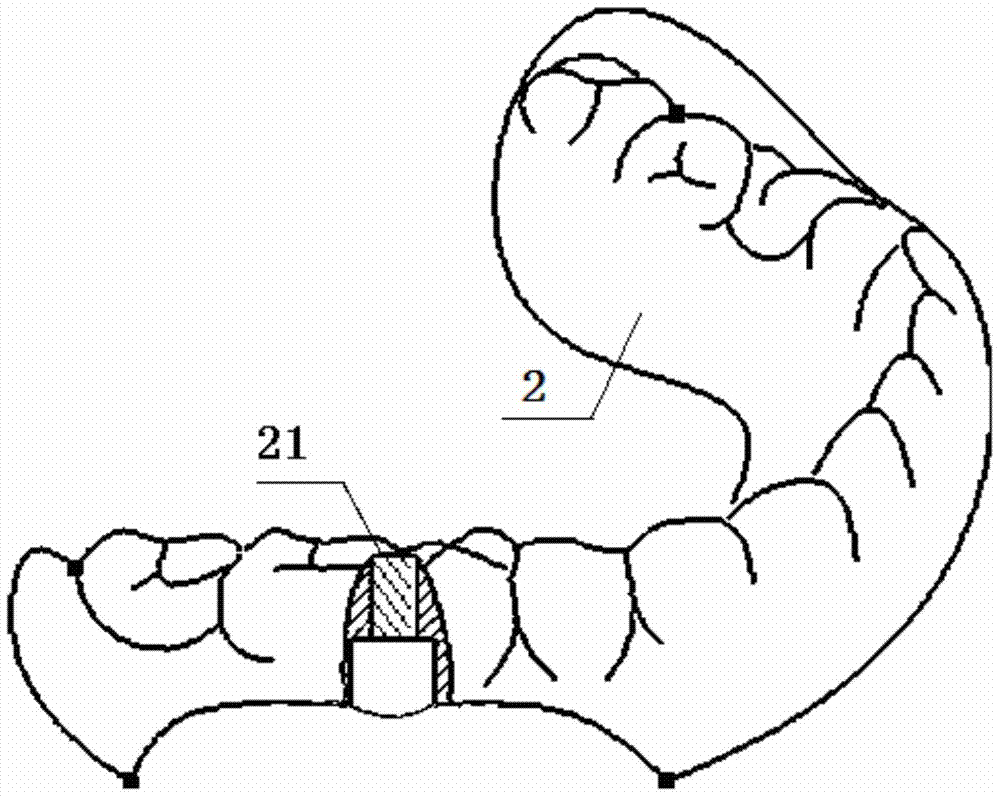 Dental implant surgery guide plate for complete tooth loss and manufacturing method thereof