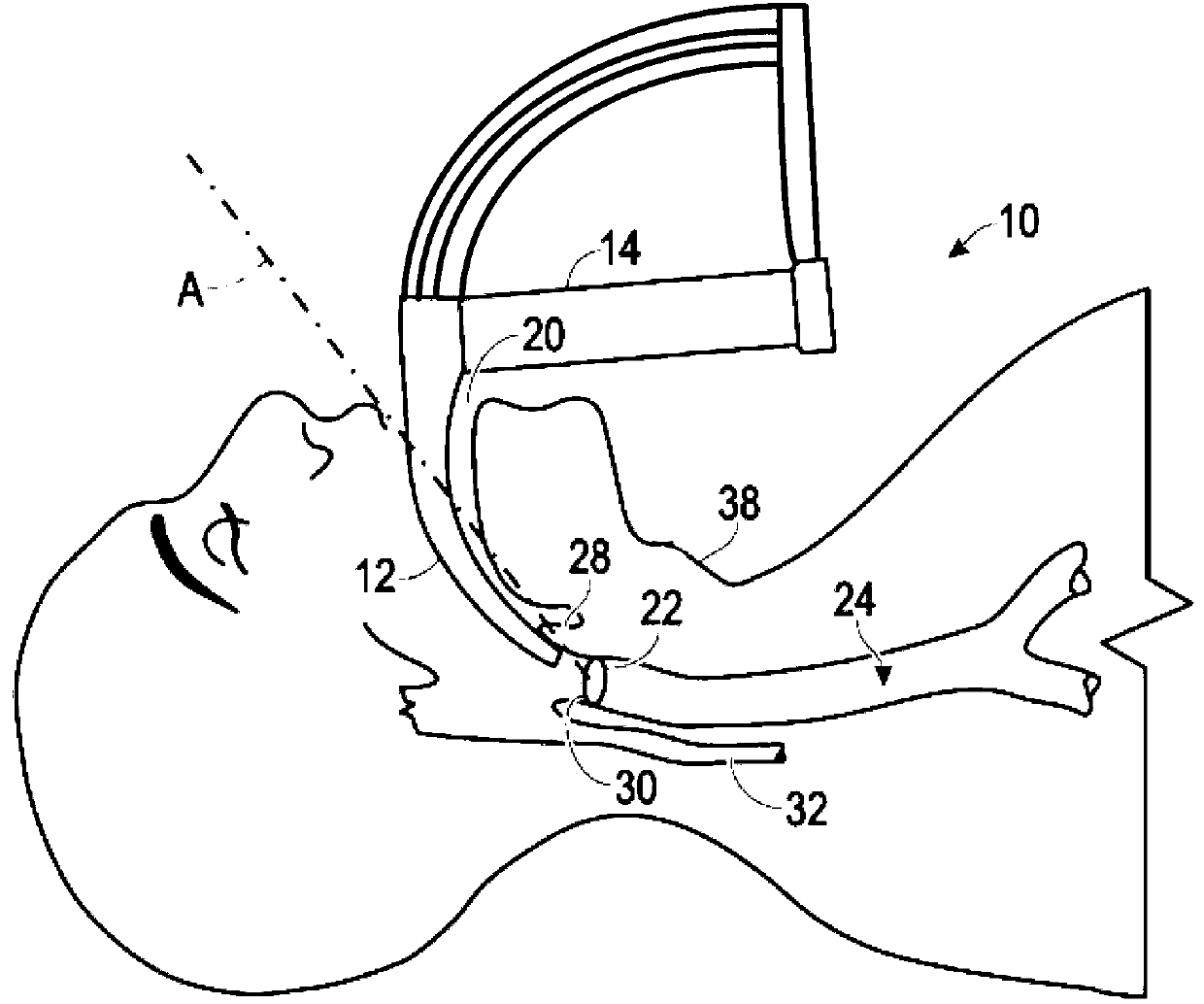 Intubation delivery systems and methods