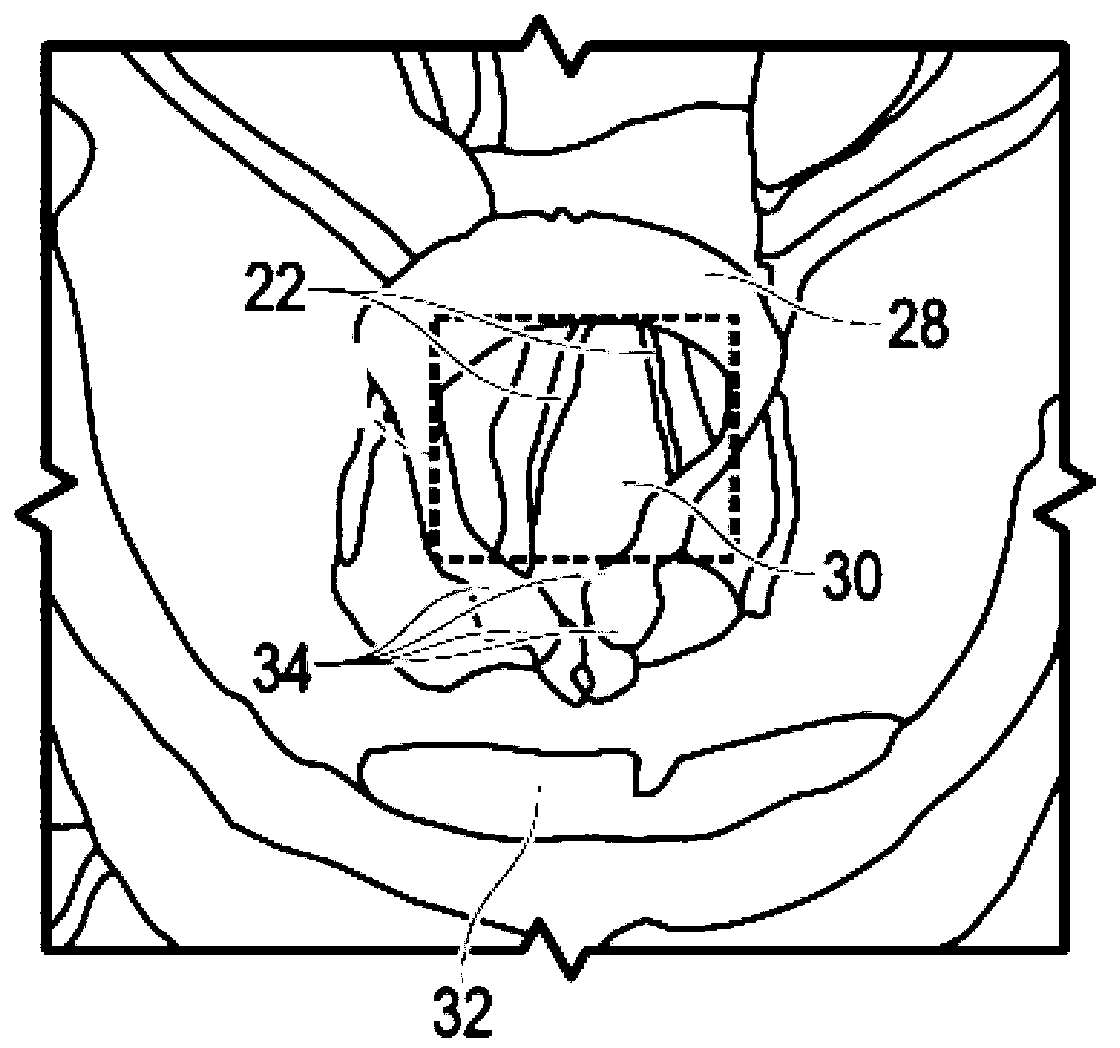 Intubation delivery systems and methods