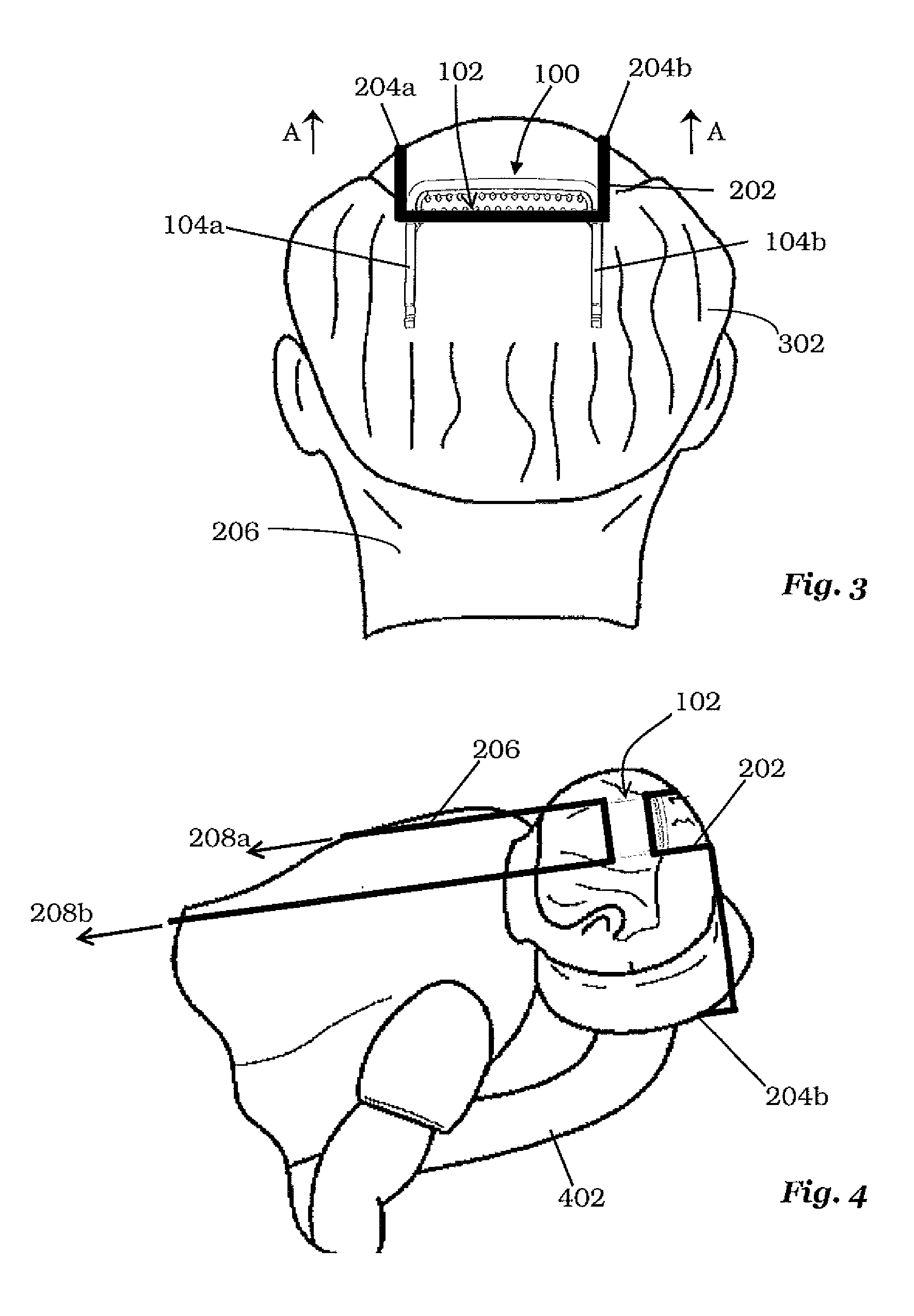 Tensioning Device and Method for Hair Transplantation