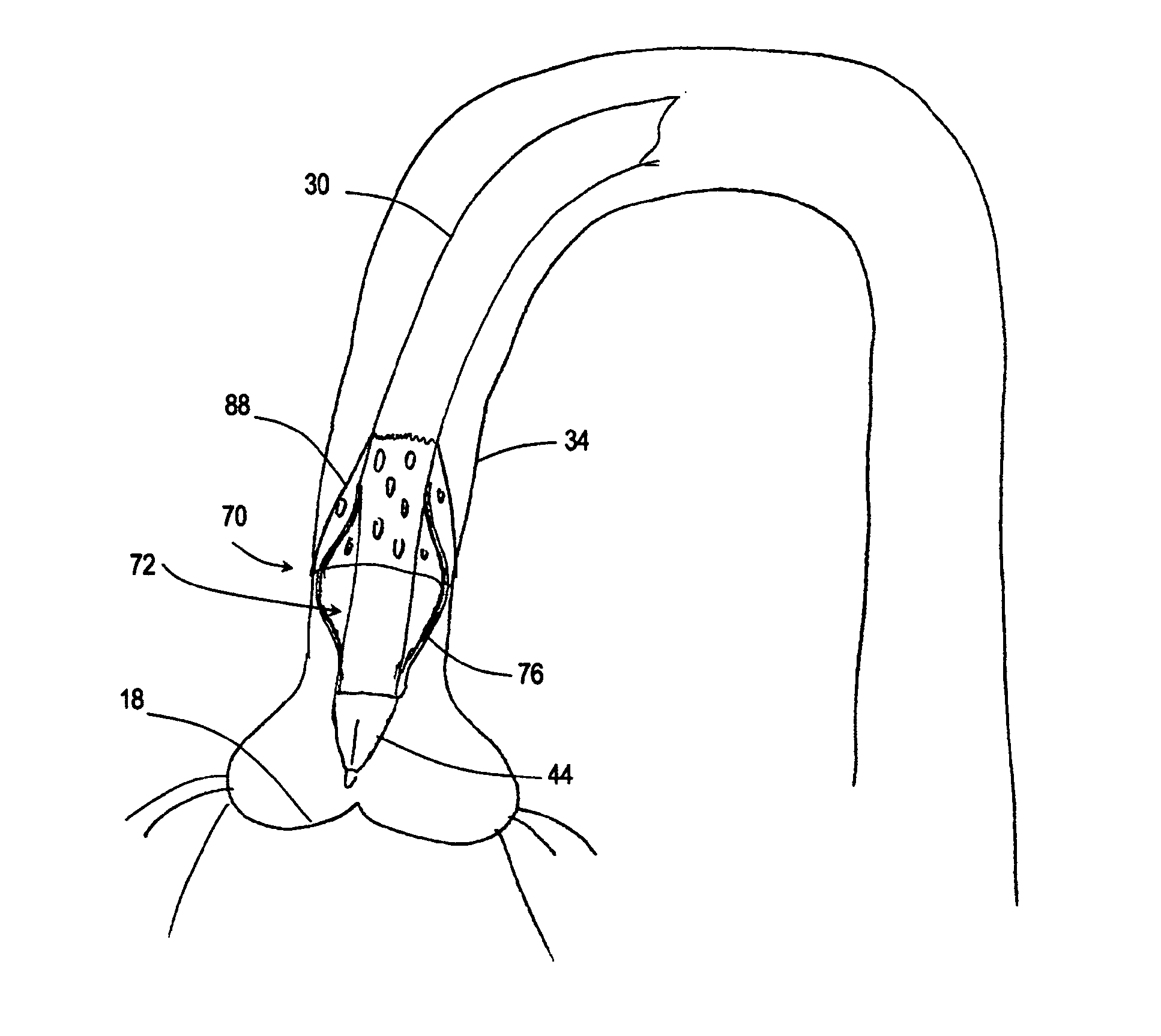 Method and Apparatus Useful for Transcatheter Aortic Valve Implantation