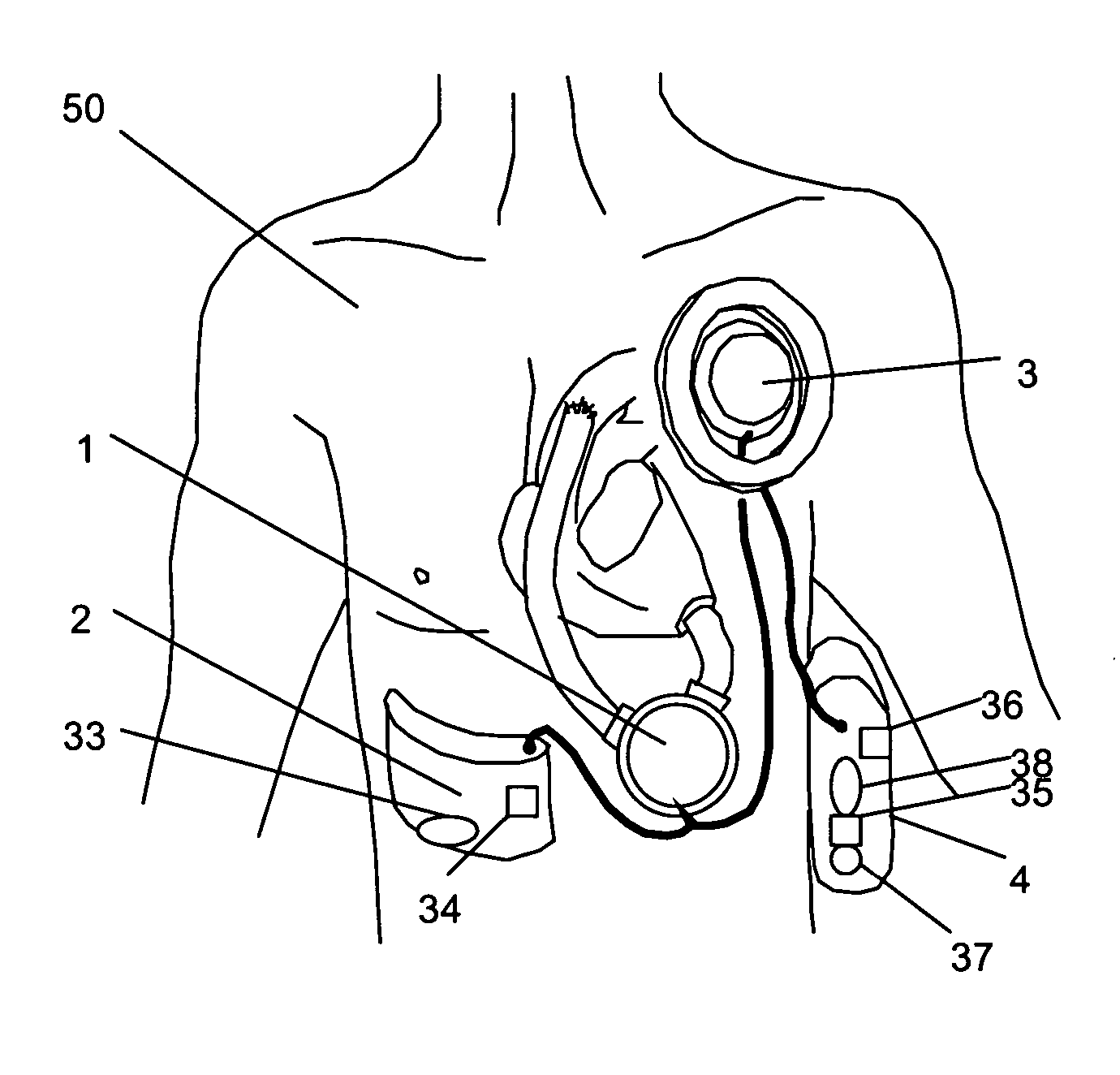 Implantable artificial ventricular assist device